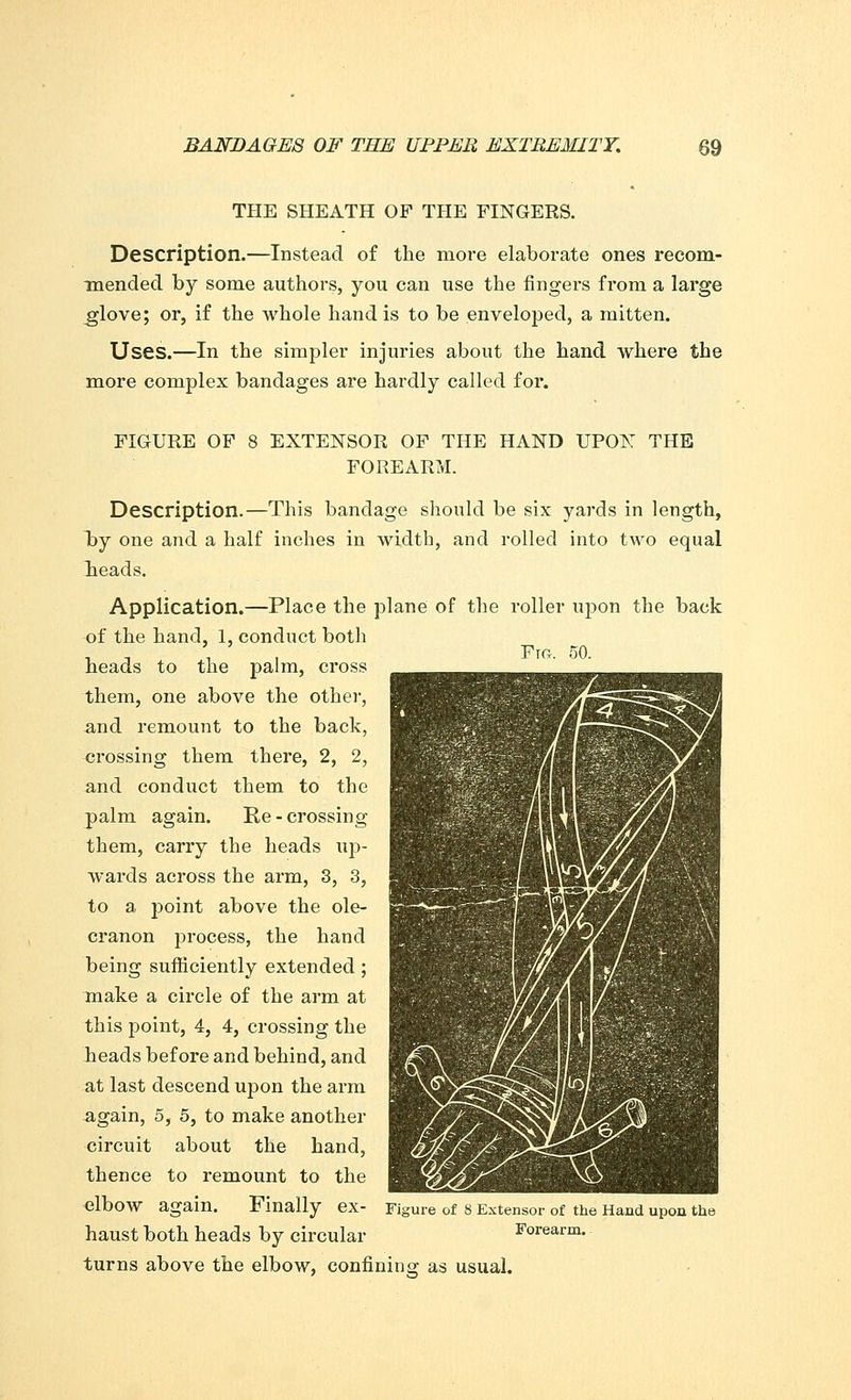 THE SHEATH OF THE FINGERS. Description.—Instead of the more elaborate ones recom- mended by some authors, you can use the fingers from a large glove; or, if the whole hand is to be enveloped, a mitten. Uses.—In the simpler injuries about the hand where the more complex bandages are hardly called for. FIGURE OF 8 EXTENSOR OF THE HAND UPON THE FOREARM. Description.—This bandage should be six yards in length, loj one and a half inches in width, and rolled into two equal heads. Application.—Place the plane of the roller upon the back of the hand, 1, conduct both heads to the palm, cross them, one above the other, and remount to the back, crossing them there, 2, 2, and conduct them to the palm again. Re - crossing them, carry the heads up- wards across the arm, 3, 3, to a point above the ole- cranon process, the hand being sufficiently extended ; make a circle of the arm at this point, 4, 4, crossing the heads before and behind, and at last descend upon the arm again, 5, 5, to make another circuit about the hand, thence to remount to the elbow again. Finally ex- haust both heads by circular turns above the elbow, confining as usual. Fig Figure of 8 Extensor of the Hand upon the Forearm.