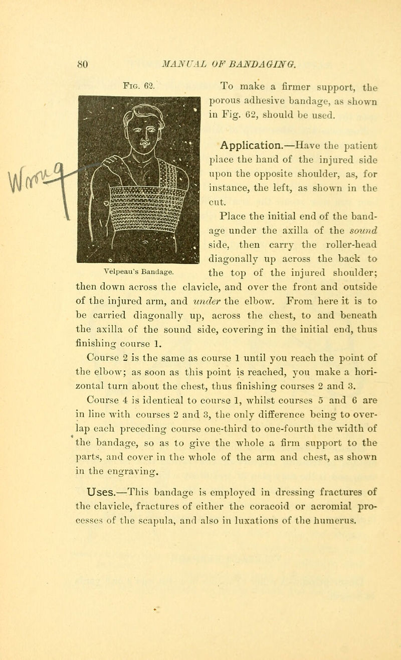 Fig. 62. To make a firmer support, the porous adhesive bandage, as shown in Fig. 62, should be used. Application.—Have the patient place the hand of the injured side upon the opposite shoulder, as, for instance, the left, as shown in the cut. Place the initial end of the band- age under the axilla of the sound side, then carry the roller-head diagonally up across the back to Veipeau's Bandage. the top of the injured shoulder; then down across the clavicle, and over the front and outside of the injured arm, and under the elbow. From here it is to be carried diagonally up, across the chest, to and beneath the axilla of the sound side, covering in the initial end, thus finishing course 1. Course 2 is the same as course 1 until you reach the point of the elbow; as soon as this point is reached, you make a hori- zontal turn about the chest, thus finishing courses 2 and 3. Course 4 is identical to course 1, whilst courses 5 and 6 are in line with courses 2 and 3, the only difference being to over- lap each preceding course one-third to one-fourth the width of the bandage, so as to give the whole a firm support to the parts, and cover in the whole of the arm and chest, as shown in the engraving. Uses.—This bandage is employed in dressing fractures of the clavicle, fractures of either the coracoid or acromial pro- cesses of the scapula, and also in luxations of the humerus.