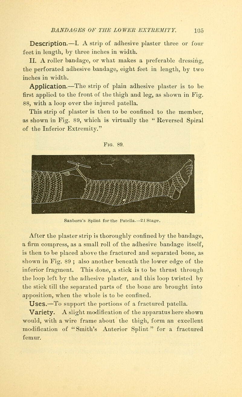 Description.—I. A strip of adhesive plaster three or four feet in length, by three inches in width. II. A roller bandage, or what makes a preferable dressing, the perforated adhesive bandage, eight feet in length, by two inches in width. Application.—The strip of plain adhesive plaster is to be first applied to the front of the thigh and leg, as shown in Fig. 88, with a loop over the injured patella. This strip of plaster is then to be confined to the member, as shown in Fig. 89, which is virtually the  Reversed Spiral of the Inferior Extremity. Fig. 89. Sanborn's Splint for the Patella.—2:1 Stage. After the plaster strip is thoroughly confined by the bandage, a firm compress, as a small roll of the adhesive bandage itself, is then to be placed above the fractured and separated bone, as shown in Fig. 89 ; also another beneath the lower edge of the inferior fragment. This done, a stick is to be thrust through the loop left by the adhesive plaster, and this loop twisted by the stick till the sepai'ated parts of the bone are brought into apposition, when the whole is to be confined. Uses.—To support the portions of a fractured patella. Variety. A slight modification of the apparatus here shown would, with a wire frame about the thigh, form an excellent modification of  Smith's Anterior Splint  for a fractured femur.