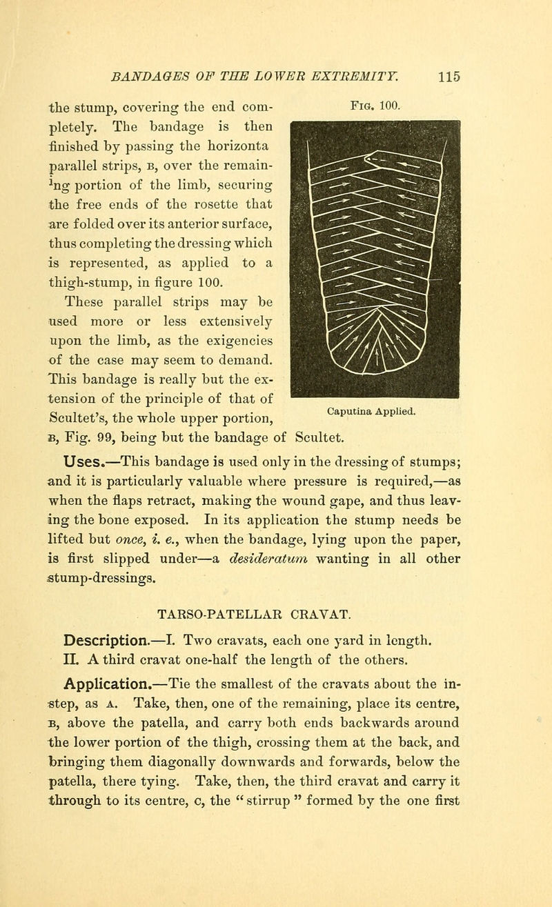 the stump, covering the end com- Fig. 100. pletely. The bandage is then finished by passing the horizonta parallel strips, b, over the remain- 1ng portion of the limb, securing the free ends of the rosette that are folded over its anterior surface, thus completing the dressing which is represented, as applied to a thigh-stump, in figure 100. These parallel strips may be used more or less extensively upon the limb, as the exigencies of the case may seem to demand. This bandage is really but the ex- tension of the principle of that of Scultet's, the whole upper portion, apu ma pp e b, Fig. 99, being but the bandage of Scultet. Uses.—This bandage is used only in the dressing of stumps; and it is particularly valuable where pressure is required,—as when the flaps retract, making the wound gape, and thus leav- ing the bone exposed. In its application the stump needs be lifted but once, i. e., when the bandage, lying upon the paper, is first slipped under—a desideratum wanting in all other stump-dressings. TARSO-PATELLAR CRAVAT. Description.—I. Two cravats, each one yard in length. IL A third cravat one-half the length of the others. Application.—Tie the smallest of the cravats about the in- step, as a. Take, then, one of the remaining, place its centre, b, above the patella, and carry both ends backwards around the lower portion of the thigh, crossing them at the back, and bringing them diagonally downwards and forwards, below the patella, there tying. Take, then, the third cravat and carry it through to its centre, c, the  stirrup  formed by the one first