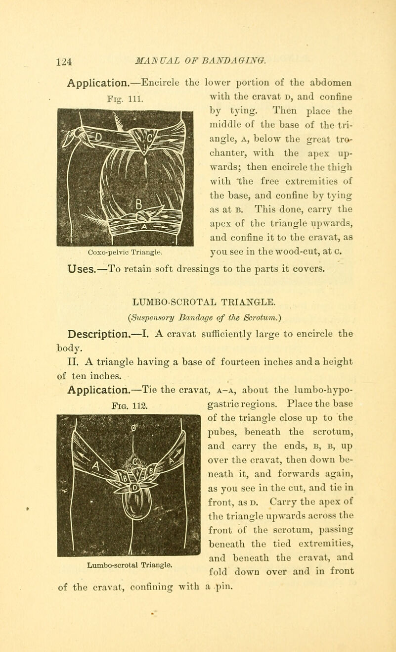 Application.—Encircle the lower portion of the abdomen Yi<r. in. with the cravat d, and confine by tying. Then place the middle of the base of the tri- angle, a, below the great tro- chanter, with the apex up- wards; then encircle the thigh with the free extremities of the base, and confine by tying as at b. This done, carry the apex of the triangle upwards, and confine it to the cravat, as Coxo-peivic Triangle. you see in the wood-cut, at c. Uses.—To retain soft dressings to the parts it covers. LUMBO-SCROTAL TRIANGLE. {Suspensory Bandage of tlie Scrotum.) Description.—I. A cravat sufficiently large to encircle the body. II. A triangle having a base of fourteen inches and a height of ten inches. Application.—Tie the cravat, a-a, about the lumbo-hypo- Fig. 112. gastric regions. Place the base of the triangle close up to the pubes, beneath the scrotum, and carry the ends, b, b, up over the cravat, then down be- neath it, and fox*wards again, as you see in the cut, and tie in front, as d. Carry the apex of the triangle upwards across the front of the scrotum, passing beneath the tied extremities, and beneath the cravat, and fold down over and in front of the cravat, confining with a pin. Lumbo-scrotal Triangle.