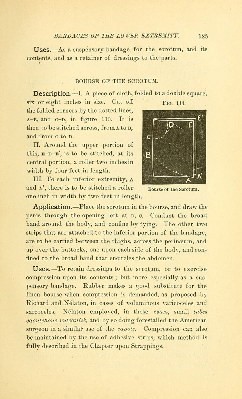 Uses.—As a suspensory bandage for the scrotum, and its contents, and as a retainer of dressings to the parts. Bourse of the Scrotum. BOURSE OF THE SCROTUM. Description.—I. A piece of cloth, folded to a double square, six or eight inches in size. Cut off Yig. 113. the folded corners by the dotted lines, a-b, and c-d, in figure 113. It is then to be stitched across, from A to b, and from c to d. II. Around the upper portion of this, e-d-e', is to be stitched, at its central portion, a roller two inches in width by four feet in length. III. To each inferior extremity, A and a', there is to be stitched a roller one inch in width by two feet in length. Application.—Place the scrotum in the bourse, and draw the penis through the opening left at d, c. Conduct the broad band around the body, and confine by tying. The other two strips that are attached to the inferior portion of the bandage, are to be carried between the thighs, across the perinaeum, and up over the buttocks, one upon each side of the body, and con- fined to the broad band that encircles the abdomen. Uses.—To retain dressings to the scrotum, or to exercise compression upon its contents ; but more especially as a sus- pensory bandage. Rubber makes a good substitute for the linen bourse when compression is demanded, as proposed by Richard and Nelaton, in cases of voluminous varicoceles and sarcoceles. Nelaton employed, in these cases, small tubes caoutchouc vulcanise, and by so doing forestalled the American surgeon in a similar use of the capote. Compression can also be maintained by the use of adhesive strips, which method is fully described in the Chapter upon Strappings.