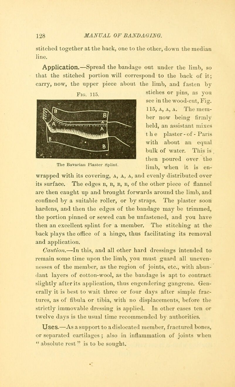 stitched together at the back, one to the other, down the median Fig. ]15. The Bavarian Plaster Splint. Application.—Spread the bandage out under the limb, bo that the stitched portion will correspond to the back of it; carry, now, the upper piece about the limb, and fasten by stiches or pins, as you see in the wood-cut, Fig. 115, a, a, a. The mem- ber now being firmly held, an assistant mixes the plaster - of - Paris with about an equal bulk of water. This is then poured over the limb, when it is en- wrapped with its covering, A, A, a, and evenly distributed over its surface. The edges b, b, b, b, of the other piece of flannel are then caught up and brought forwards around the limb, and confined by a suitable roller, or by straps. The plaster soon hardens, and then the edges of the bandage may be trimmed, the portion pinned or sewed can be unfastened, and you have then an excellent splint for a member. The stitching at the back plays the office of a hinge, thus facilitating its removal and application. Caution.—In this, and all other hard dressings intended to remain some time upon the limb, you must guard all uneven- nesses of the member, as the region of joints, etc., with abun- dant layers of cotton-wool, as the bandage is apt to contract slightly after its application, thus engendering gangrene. Gen- erally it is best to wait three or four days after simple frac- tures, as of fibula or tibia, with no displacements, before the strictly immovable dressing is applied. In other cases ten or twelve days is the usual time recommended by authorities. Uses.—As a support to a dislocated member, fractured bones, or separated cartilages; also in inflammation of joints when  absolute rest  is to be sought.