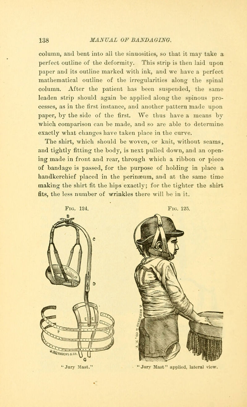 column, and bent into all the sinuosities, so that it may take a perfect outline of the deformity. This strip is then laid upon paper and its outline marked with ink, and we have a perfect mathematical outline of the irregularities along the spinal column. After the patient has been suspended, the same leaden strip should again be applied along the spinous pro- cesses, as in the first instance, and another pattern made upon paper, by the side of the first. We thus have a means by which comparison can be made, and so are able to determine exactly what changes have taken place in the curve. The shirt, which should be woven, or knit, without seams, and tightly fitting the body, is next pulled down, and an open- ing made in front and rear, through which a ribbon or piece of bandage is passed, for the purpose of holding in place a handkerchief placed in the perinaeum, and at the same time making the shirt fit the hips exactly; for the tighter the shirt fits, the less number of wrinkles there will be in it. Fig. 125. '^YNDEB'se.co.U IT G '• Jury Mast. Jury Mast applied, lateral new.