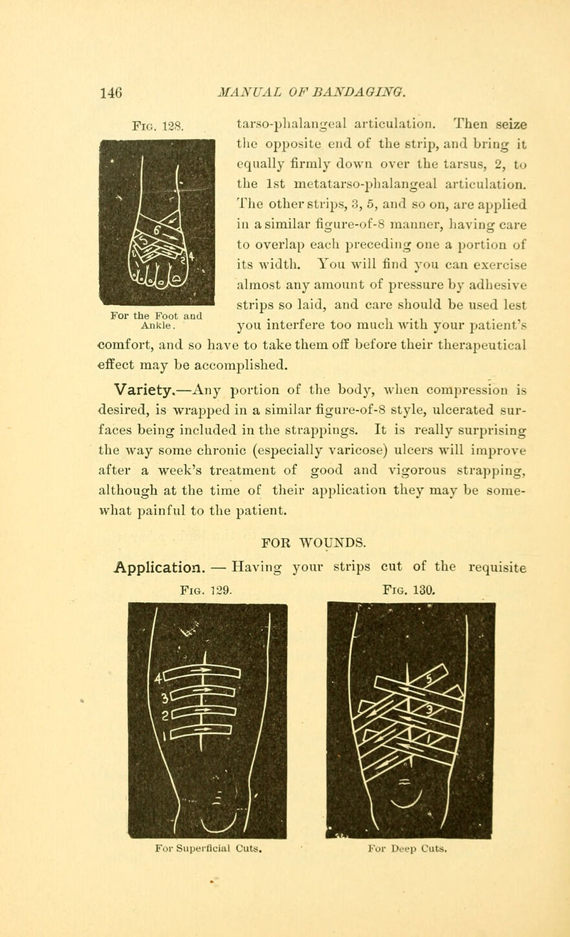 tarso-plialangeal articulation. Then seize the opposite end of the strip, and bring it equally firmly down over the tarsus, 2, fco the 1st metatarsophalangeal articulation. The other strips, 3, 5, and so on, are applied in a similar figure-of-8 manner, having care to overlap each preceding one a portion of its width. You will find you can exercise almost any amount of pressure by adhe;-i\ e strips so laid, and care should be used lest you interfere too much with your patient's comfort, and so have to take them off before their therapeutical effect may be accomplished. Variety.—Any portion of the body, when compression is desired, is wrapped in a similar figure-of-8 style, ulcerated sur- faces being included in the strappings. It is really surprising the way some chronic (especially varicose) ulcers will improve after a week's treatment of good and vigorous strapping, although at the time of their application they may be some- what jminful to the patient. For the Foot and Ankle. Application. — Fig. 129 FOR WOUNDS. Having your strips cut of the requisite Fig. 130. For Superficial Cuts. For Deep Cuts.
