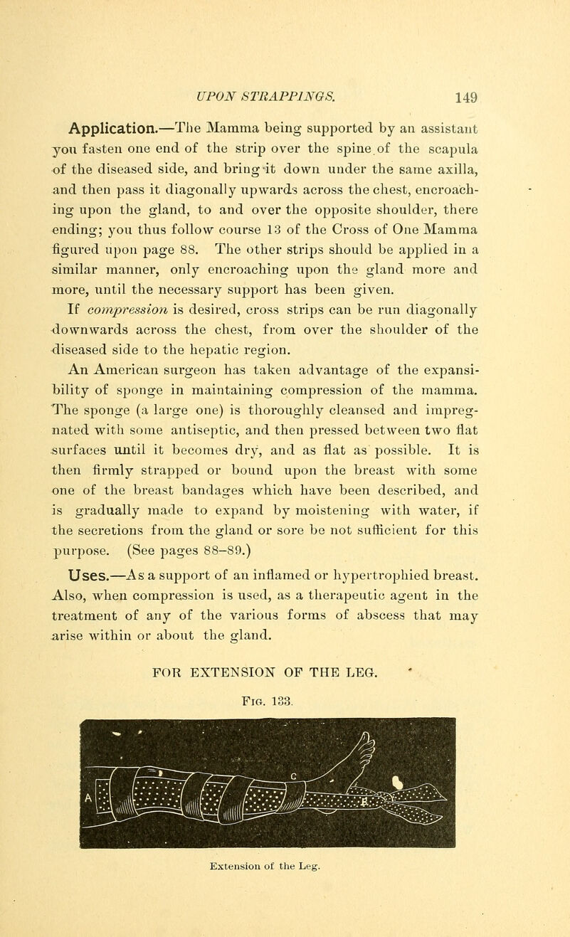 Application.—The Mamma being supported by an assistant you fasten one end of the strip over the spine.of the scapula of the diseased side, and bring it down under the same axilla, and then pass it diagonally upwards across the chest, encroach- ing upon the gland, to and over the opposite shoulder, there ending; you thus follow course 13 of the Cross of One Mamma figured upon page 88. The other strips should be applied in a similar manner, only encroaching upon the gland more and more, until the necessary support has been given. If compression is desired, cross strips can be run diagonally downwards across the chest, from over the shoulder of the diseased side to the hepatic region. An American surgeon has taken advantage of the expansi- bility of sponge in maintaining compression of the mamma. The sponge (a large one) is thoroughly cleansed and impreg- nated with some antiseptic, and then pressed between two flat surfaces until it becomes dry, and as flat as possible. It is then firmly strapped or bound upon the breast with some one of the breast bandages which have been described, and is gradually made to expand by moistening with water, if the secretions from the gland or sore be not sufficient for this purpose. (See pages 88-89.) Uses.—As a support of an inflamed or hypertrophied breast. Also, when compression is used, as a therapeutic agent in the treatment of any of the various forms of abscess that may arise within or about the gland. FOR EXTENSION OF THE LEG. Fig. 133. Extension of the Leg.