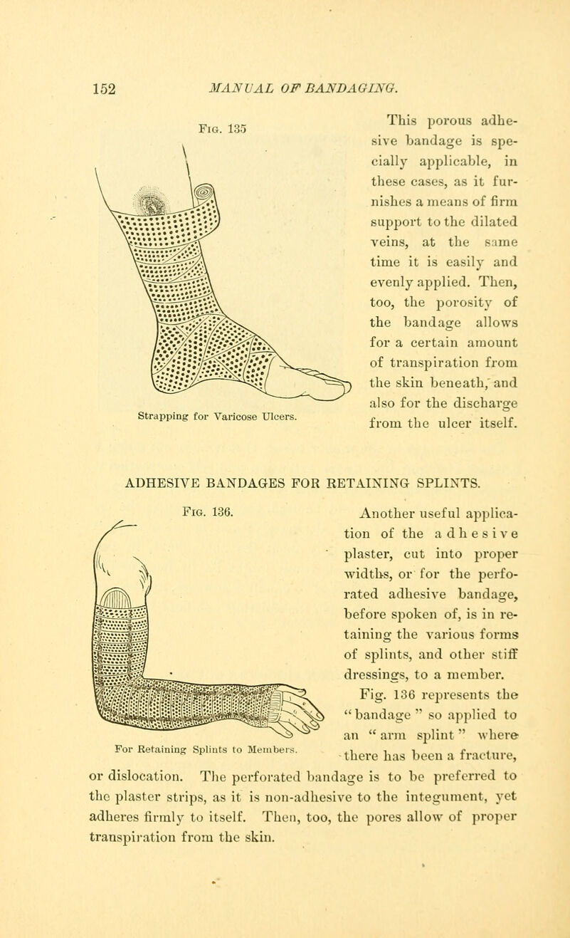 Fig. 135 Strapping for Varicose Ulcers. This porous adhe- sive bandage is spe- cially applicable, in these cases, as it fur- nishes a means of firm support to the dilated veins, at the same time it is easily and evenly applied. Then, too, the porosity of the bandage allows for a certain amount of transpiration from the skin beneath, and also for the discharge from the ulcer itself. ADHESIVE BANDAGES FOR RETAINING SPLINTS. Fig. 136. Another useful applica- tion of the adhesive plaster, cut into proper widths, or for the perfo- rated adhesive bandage, before spoken of, is in re- taining the various forms of splints, and other stiff dressings, to a member. Fig. 136 represents the bandage so applied to an  arm splint  where For Retaining Splints to Members. .-, , ■, »_ . ,„„ 6 * -thei'e has been a fracture, or dislocation. The perforated bandage is to be preferred to the plaster strips, as it is non-adhesive to the integument, yet adheres firmly to itself. Then, too, the pores allow of proper transpiration from the skin.