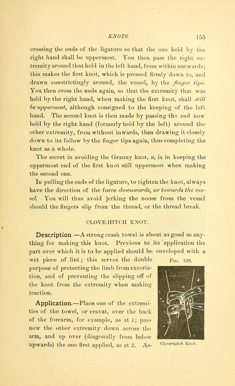 crossing the ends of the ligature so that the one held by the right hand shall be uppermost. You then pass the right ex- tremity ai-ound that held in the left hand, from within otit wards; this makes the first knot, which is pressed firmly down to, and drawn constrictingly around, the vessel, by the finger tips. You then cross the ends again, so that the extremity that was held by the right hand, when making the first knot, shall still be icppermost, although consigned to the keeping of the left hand. The second knot is then made by passing the end now held by the right hand (formerly held by the left) around the other extremity, from without inwards, then drawing it closely down to its fellow by the finger tips again, thus completing the knot as a whole. The secret in avoiding the Granny knot, b, is in keeping the uppermost end of the first knot still uppermost when making the second one. In pulling the ends of the ligature, to tighten the knot, always have the direction of the force downwards, or towards the ves- sel. You will thus avoid jerking the noose from the vessel should the fingers slip from the thread, or the thread break. CLOVE-HITCH KNOT. Description —A strong crash towel is about as good as any- thing for making this knot. Previous to its application the part over which it is to be applied should be enveloped with a wet piece of lint; this serves the double Yig. 138. purpose of protecting the limb from excoria- tion, and of preventing the slipping off of the knot from the extremity when making traction. Application.—Place one of the extremi- ties of the towel, or cravat, over the back of the forearm, for example, as at 1; pass now the other extremity down across the arm, and up over (diagonally from below upwards) the one first applied, as at 2. As- ciove-wtch Knot.