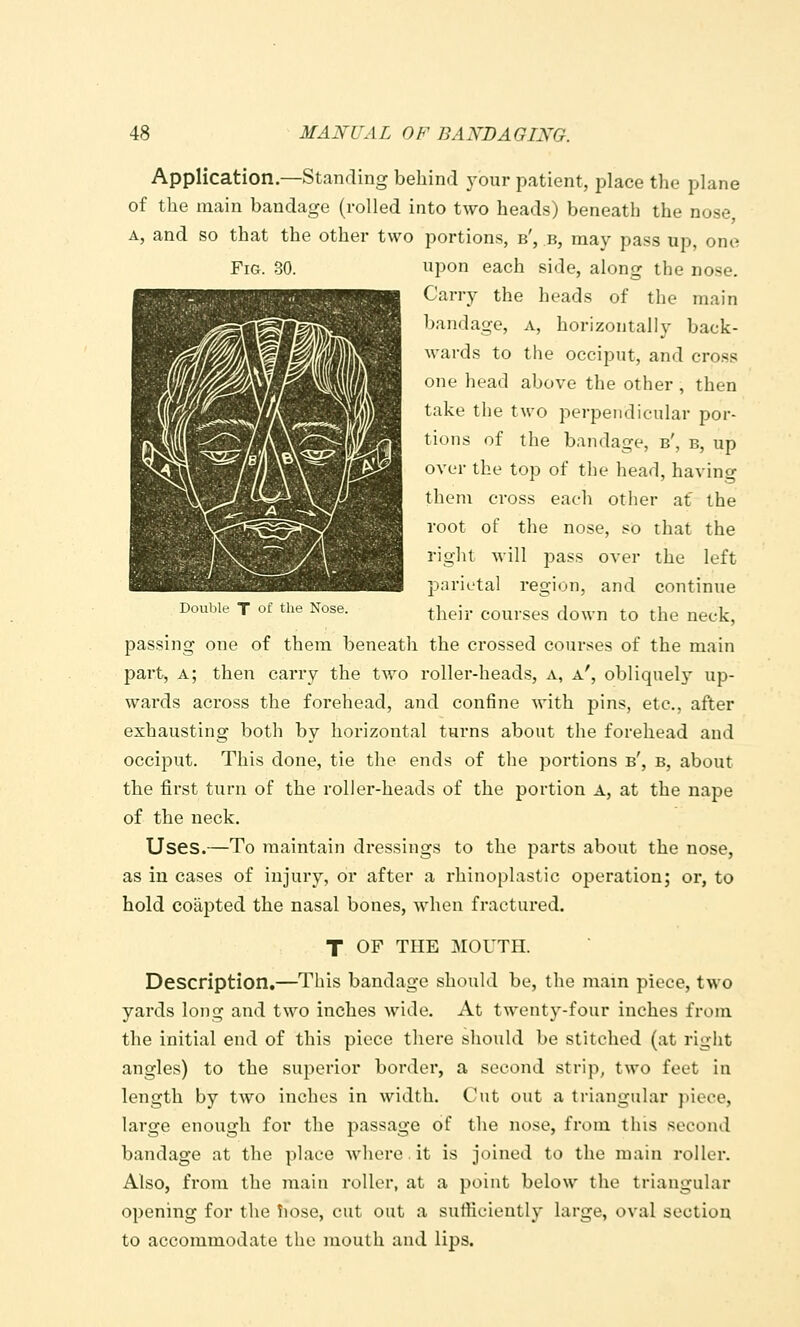 Fig. 30. Double T of the Nose. Application.—Standing behind your patient, place the plane of the main bandage (rolled into two heads) beneath the nose, A, and so that the other two portions, b', b, may pass up, one upon each side, along the nose. Carry the heads of the main bandage, a, horizontally back- wards to the occiput, and cross one head above the other , then take the two perpendicular por- tions of the bandage, b', b, up over the top of tlie liead, having them cross each other at the root of the nose, so that the right will pass over the left parietal region, and continue their courses down to the neck, passing one of them beneath the crossed courses of the main part, a; then carry the two roller-heads, a, a', obliquely up- wards across the forehead, and confine with pins, etc., after exhausting both by horizontal turns about the forehead and occiput. This done, tie the ends of the poi'tions b', b, about the first turn of the roller-heads of the portion A, at the nape of the neck. Uses.—To maintain dressings to the parts about the nose, as in cases of injury, or after a rhinoplastic operation; or, to hold coapted the nasal bones, when fractured. T OF THE MOUTH. Description.—This bandage should be, the main piece, two yards long and two inches wide. At twenty-four inches from the initial end of this piece there should be stitched (at right angles) to the superior border, a second strip, two feet in length by two inches in width. Cut out a triangular piece, large enough for the passage of the nose, from this second bandage at the place where it is joined to the main roller. Also, from the main roller, at a point below the triangular opening for the Tiose, cut out a sufficiently large, oval section to accommodate the mouth and lips.