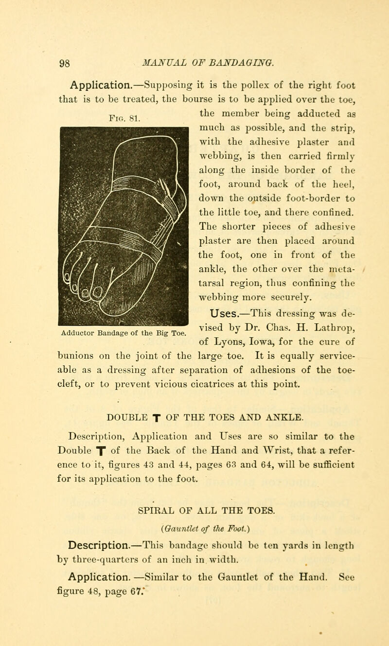 Fro. 81. Application.—Supposing it is the pollex of the right foot that is to be treated, the bourse is to be applied over the toe, the member being adducted as much as possible, and the strip, with the adhesive plaster and webbing, is then carried firmly along the inside border of the foot, around back of the heel, down the outside foot-border to the little toe, and there confined. The shorter pieces of adhesive plaster are then placed around the foot, one in front of the ankle, the other over the meta- tarsal region, thus confining the webbing more securely. Uses.—This dressing was de- vised by Dr. Chas. H. Lathrop, of Lyons, Iowa, for the cure of bunions on the joint of the large- toe. It is equally service- able as a dressing after separation of adhesions of the toe- cleft, or to prevent vicious cicatrices at this point. Adductor Bandage of the Big Toe. DOUBLE T OF THE TOES AND ANKLE. Description, Application and Uses are so similar to the Double T of t^6 Back of the Hand and Wrist, that a refer- ence to it, figures 43 and 44, pages 63 and 64, will be sufficient for its application to the foot. SPIRAL OF ALL THE TOES. (Gauntlet of the Foot.) Description.—This bandage should be ten yards in length by three-quarters of an inch in, width. Application. —Similar to the Gauntlet of the Hand. See figure 48, page 67^