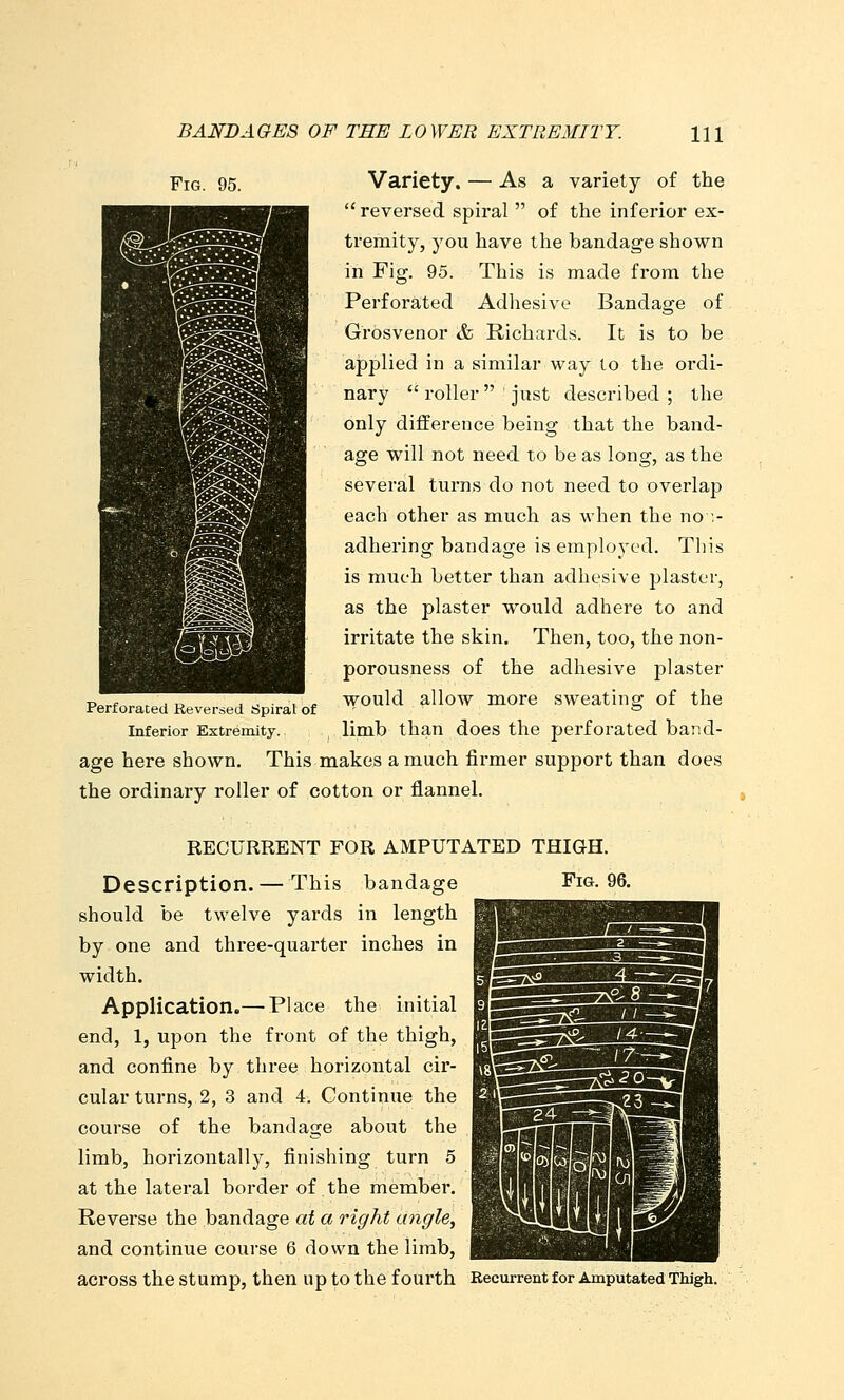 Fig. 95. Variety. — As a variety of the  reversed spiral  of the inferior ex- tremity, you have the bandage shown in Fig. 95. This is made fi'om the Perforated Adliesive Bandage of Grosvenor & Richards. It is to be applied in a similar way to the ordi- nary  roller  ' just described ; the only difference being that the band- age will not need to be as long, as the several turns do not need to overlap each other as much as when the no > adhering bandage is employed. This is much better than adhesive plaster, as the plaster would adhere to and irritate the skin. Then, too, the non- porousness of the adhesive plaster would allow more sweating of the limb than does the perforated band- age here shown. This makes a much firmer support than does the ordinary roller of cotton or flannel. Perforated Reversed Spiral of Inferior Extremity. RECURRENT FOR AMPUTATED THIGH. Description.— This bandage Fig. 96. should be twelve yards in length by one and three-quarter inches in width. Application.— Place the initial end, 1, upon the front of the thigh, and confine by three horizontal cir- cular turns, 2, 3 and 4. Continue the course of the bandage about the limb, horizontally, finishing turn 5 at the lateral border of the member. Reverse the bandage at a right angle, and continue course 6 down the limb, across the stump, then up to the fourth Recurrent for Amputated Thigh.