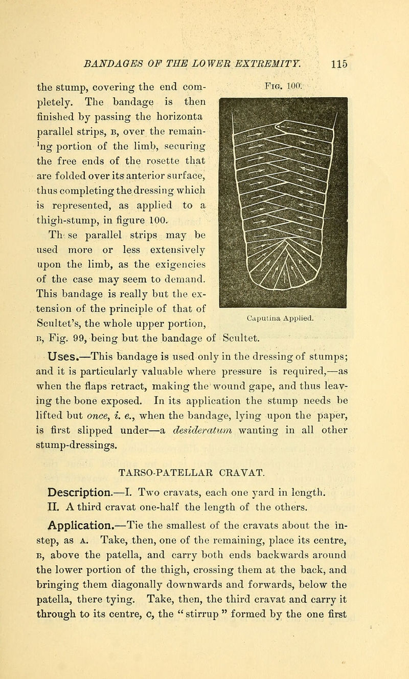 the stump, covering the end com- Fig. 100. pletely. The bandage is then finished by passing the horizonta parallel strips, b, over the remain- ing portion of the limb, securing the free ends of the rosette that are folded over its anterior surface, thus completing the dressing which is represented, as applied to a thigh-stump, in figure 100. Th'. se parallel strips may be used more or less extensively upon the limb, as the exigencies of the case may seem to demand. This bandage is really but the ex- tension of the principle of that of Scultet's, the whole upper portion, B, Fig. 99, being but the bandage of Scultet. Uses.—This bandage is used only in the dressing of stumps; and it is particularly valuable where pressure is required,—as when the flaps retract, making the wound gape, and thus leav^ ing the bone exposed. In its application the stump needs be lifted but once, i. e., when the bandage, lying upon the paper, is first slipped under—a desideratwn wanting in all other stump-dressings. Caputina Applied. TARSO-PATELLAR CRAVAT. Description.—1. Two cravats, each one yard in length. II. A third cravat one-half the length of the others. Application.—Tie the smallest of the cravats about the in- step, as A. Take, then, one of the remaining, place its centre, B, above the patella, and carry both ends backwards around the lower portion of the thigh, crossing them at the back, and bringing them diagonally downwards and forwards, below the patella, there tying. Take, then, the third cravat and carry it through to its centre, C, the  stirrup  formed by the one first