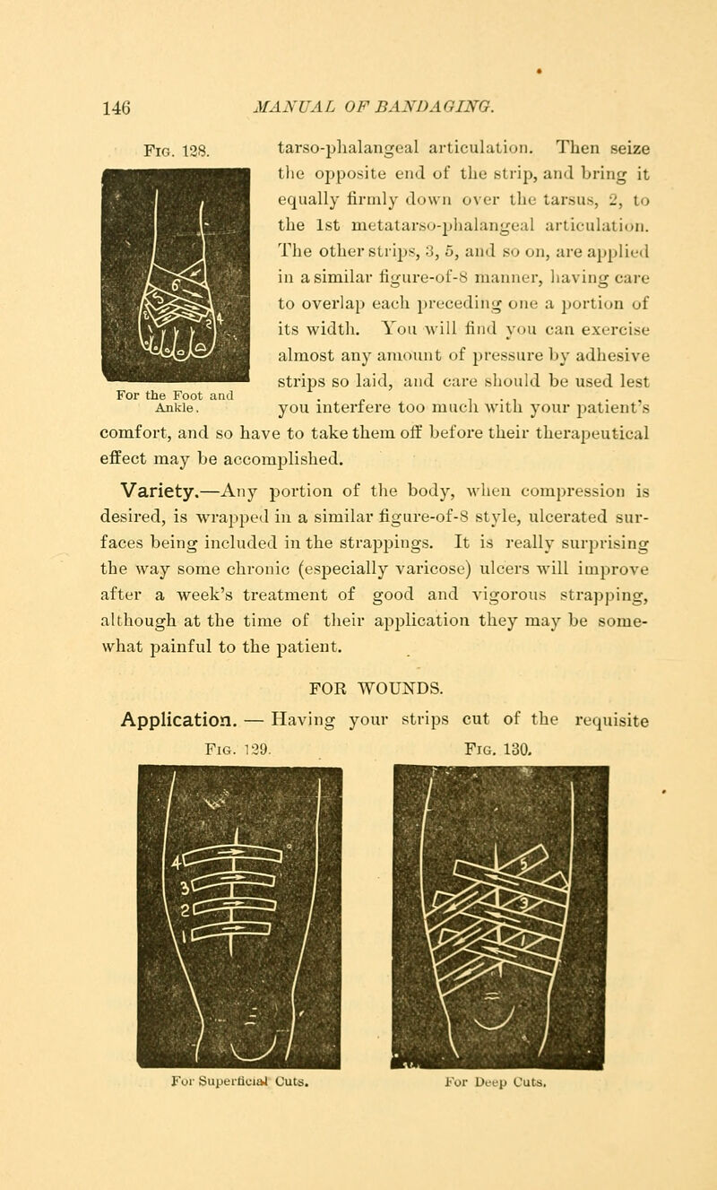 Fig, 128. tarso-i:)lialangeal articulation. Then seize tlie opposite end of the strip, and bring it equally firmly down over the tarsus, 2, to the 1st metatarso-jjlialangeal articulati(jn. The other strips, 3, 5, and so on, are applied in a similar figure-oi-8 manner, having care to overlap each preceding one a portion of its width. You will find you can exercise almost any amount of pressure by adhesive strips so laid, and care should be used lest you interfere too much with your patient's comfort, and so have to take them off before their therapeutical effect may be accomplished. Variety.—Any portion of the body, when compression is desired, is wrapped in a similar figure-of-S style, ulcerated sur- faces being included in the strappings. It is really surprising the way some chronic (especially varicose) ulcers will improve after a week's treatment of good and vigorous strapping, although at the time of tlieir application they may be some- what painful to the patient. For the Foot and Ankle. FOR WOUNDS. Application. — Having your strips cut of the requisite Fig. 129. Fig. 130. For Supertioiivl Cuts. For Deep Cuts.