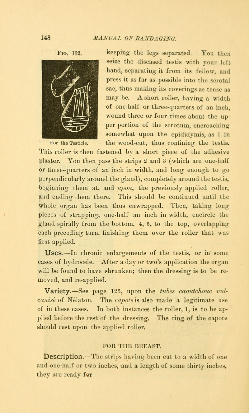 Pig. 132. keeping the legs separated. You then seize the diseased testis with your left hand, separating it from its fellow, and press it as far as possible into the scrotal sac, thus making its coverings as tense as may be. A short roller, having a width of one-half or three-quarters of an inch, wound three or four times about the up- per portion of the scrotum, encroaching somewhat upon the epididymis, as 1 in For the Testicle. the wood-cut, thus confining the testis. This roller is then fastened by a short piece of the adiiesive plaster. You then pass the strips 2 and 3 (which are one-half or three-quarters of an inch in width, and long enough to go perpendicularly around the gland), completely around the testis, beginning them at, and upon, the previously applied roller, and ending them there. This should be continued until the whole organ has been thus enwrapped. Then, taking long pieces of strapping, one-half an inch in width, encircle the gland spirally from the bottom, 4, 5, to the top, overlapping each preceding turn, finishing them over the roller that was first applied. Uses.—In chronic enlargements of the testis, or in some cases of hydrocele. After a day or two's application the organ will be found to have shrunken; then the dressing is to be re- moved, and re-applied. Variety.—See page 125, upon the tubes caoutchouc vul- canise oi Nelaton. The ca/>o^e is also made a legitimate use of in these cases. In both instances the roller, 1, is to be ap- plied before the rest of the dressing. The ring of the capote should rest upon the apjjlied roller. FOR THE BREAST. Description.—The strips having been cut to a width of one and one-half or two inches, and a length of some thirty inches, they are ready for
