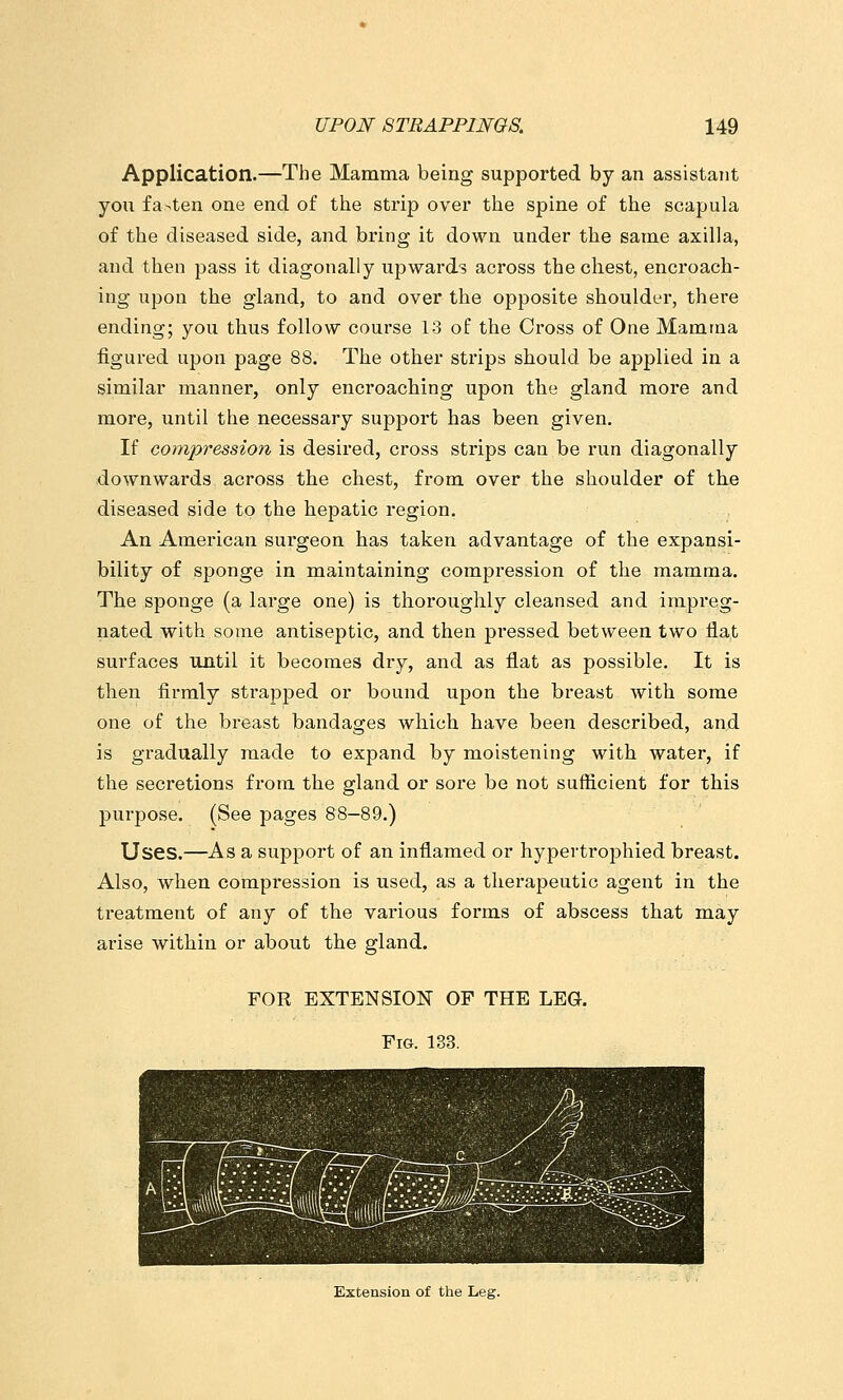 Application.—The Mamma being supported by an assistant you fasten one end of the strip over the spine of the scapula of the diseased side, and bring it down under the same axilla, and then pass it diagonally upwards across the chest, encroach- ing upon the gland, to and over the opposite shoulder, there ending; you thus follow course 13 of the Cross of One Mamma figured upon page 88. The other strips should be applied in a similar manner, only encroaching upon the gland more and more, until the necessary support has been given. If compression is desired, cross strips can be run diagonally downwards across the chest, from over the shoulder of the diseased side to the hepatic region. An American surgeon has taken advantage of the expansi- bility of sponge in maintaining compression of the mamma. The sponge (a large one) is thoroughly cleansed and impreg- nated with some antiseptic, and then pressed between two flat sm-faces until it becomes dry, and as flat as possible. It is then firmly strapped or bound upon the breast with some one of the breast bandages which have been described, and is gradually made to expand by moistening with water, if the secretions from the gland or sore be not sufficient for this purpose. (See pages 88-89.) Uses.—As a support of an inflamed or hypertrophied breast. Also, when compression is used, as a therapeutic agent in the treatment of any of the various forms of abscess that may arise within or about the gland. FOR EXTENSION OF THE LEG. Fig. 133. Extension of the Leg.