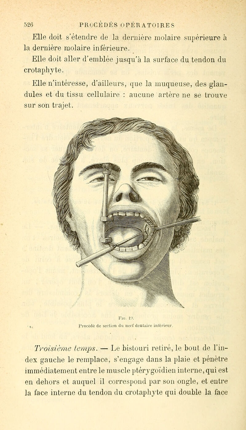 Elle doit s'étendre de la dernière molaire supérieure à la dernière molaire inférieure. Elle doit aller d'emblée jusqu'à la surface du tendon du crotaphyte. Elle n'intéresse, d'ailleurs, que la muqueuse, des glan- dules et du tissu cellulaire : aucune artère ne se trouve sur son trajet. Vu:, l'.i. Procédé de section du nerf denUdre inlérieur. Troisième te)nps. — Le bistouri retiré, le bout de l'in- dex gauche le remplace, s'engage dans la plaie et pénètre immédiatement entre le muscle ptérygoïdien interne, qui est en dehors et auquel il correspond par son ongle, et entre la face interne du tendon du crotaphyte qui double la face