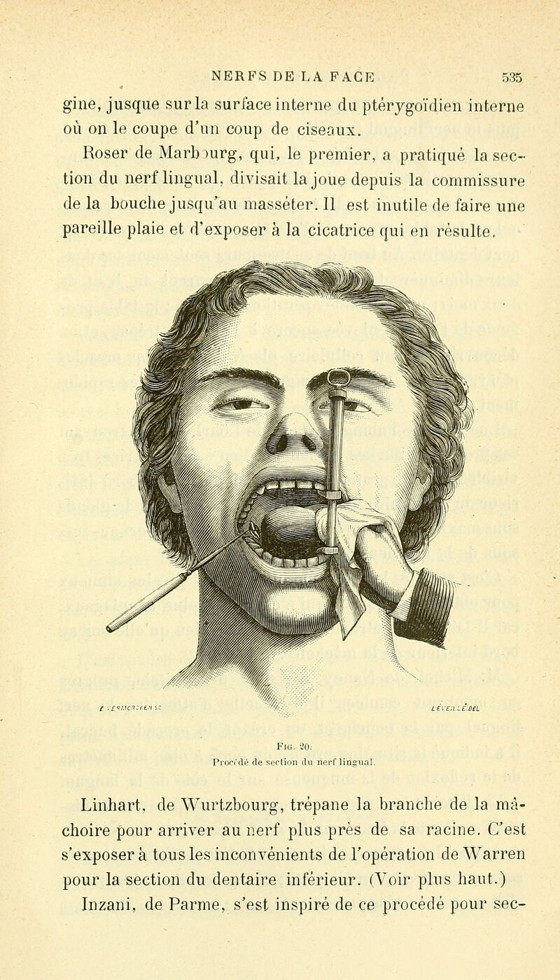 gine, jusque sur la surface interne du ptérygoïdien interne où on le coupe d'un coup de ciseaux. Roser de Marb )urg, qui, le premier, a pratiqué la sec- tion du nerf lingual, divisait la joue depuis la commissure de la bouche jusqu'au masséter. 11 est inutile de faire une pareille plaie et d'exposer à la cicatrice qui en résulte. c scttM^fZil.n se l^ve:lie.ul Fia. 20. Procfdé de section du neii'linsiial. Linhart, de Wurtzbourg, trépane la branche de la mâ- choire pour arriver au nerf plus près de sa racine. C'est s'exposera tous les inconvénients de l'opération de Warren pour la section du dentaire inférieur. (Voir plus haut.) Inzani, de Parme, s'est inspiré de ce procédé pour sec-