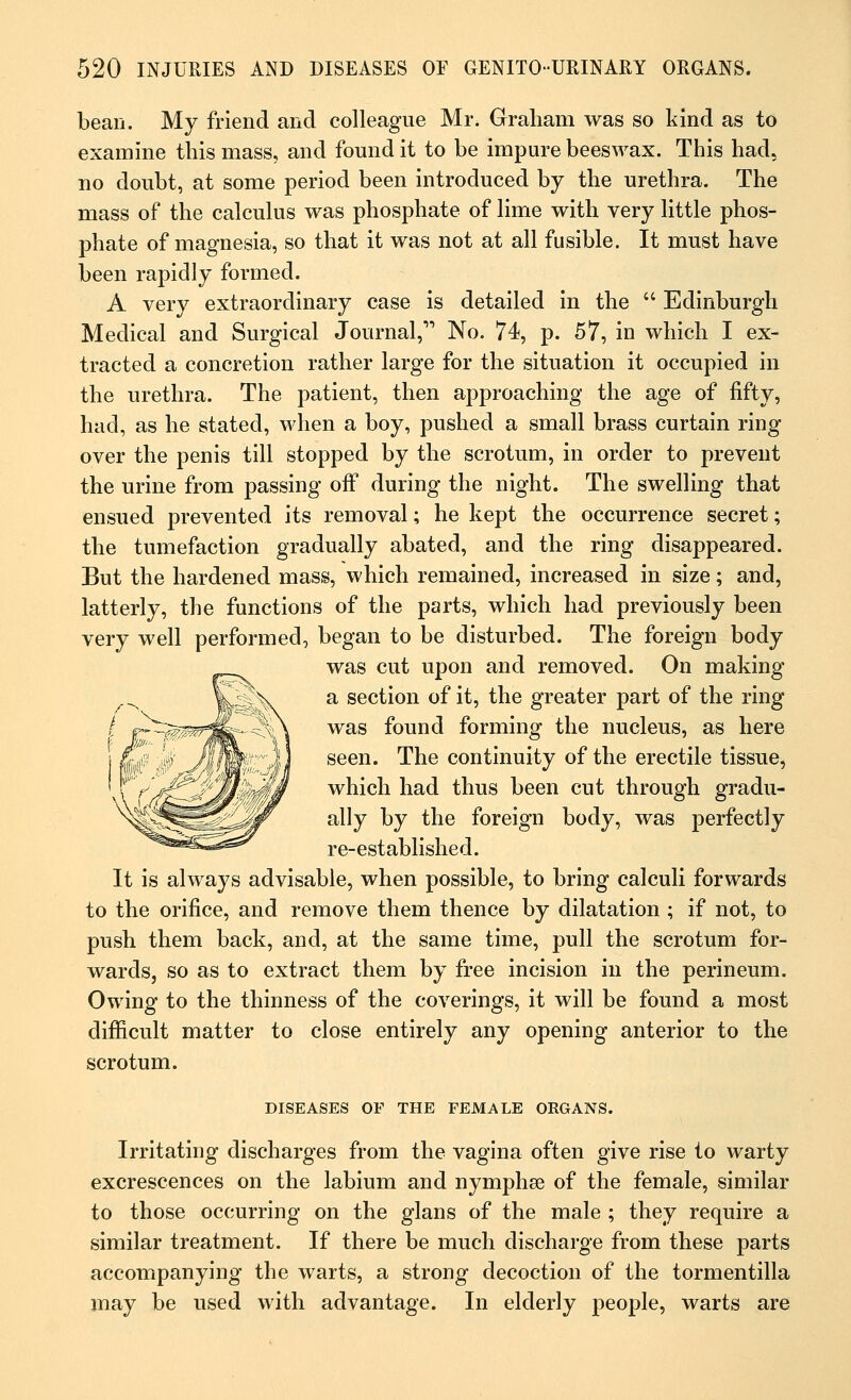 bean. My friend and colleague Mr. Graham was so kind as to examine this mass, and found it to be impure beeswax. This had, no doubt, at some period been introduced by the urethra. The mass of the calculus was phosphate of lime with very little phos- phate of magnesia, so that it was not at all fusible. It must have been rapidly formed. A very extraordinary case is detailed in the  Edinburgh Medical and Surgical Journal,1'' No. 74, p. 57, in which I ex- tracted a concretion rather large for the situation it occupied in the urethra. The patient, then approaching the age of fifty, had, as he stated, when a boy, pushed a small brass curtain ring over the penis till stopped by the scrotum, in order to prevent the urine from passing off during the night. The swelling that ensued prevented its removal; he kept the occurrence secret; the tumefaction gradually abated, and the ring disappeared. But the hardened mass, which remained, increased in size; and, latterly, the functions of the parts, which had previously been very well performed, began to be disturbed. The foreign body was cut upon and removed. On making a section of it, the greater part of the ring was found forming the nucleus, as here seen. The continuity of the erectile tissue, which had thus been cut through gradu- ally by the foreign body, was perfectly re-established. It is always advisable, when possible, to bring calculi forwards to the orifice, and remove them thence by dilatation ; if not, to push them back, and, at the same time, pull the scrotum for- wards, so as to extract them by free incision in the perineum. Owing to the thinness of the coverings, it will be found a most difficult matter to close entirely any opening anterior to the scrotum. DISEASES OF THE FEMALE ORGANS. Irritating discharges from the vagina often give rise to warty excrescences on the labium and nymphse of the female, similar to those occurring on the glans of the male ; they require a similar treatment. If there be much discharge from these parts accompanying the warts, a strong decoction of the tormentilla may be used with advantage. In elderly people, warts are