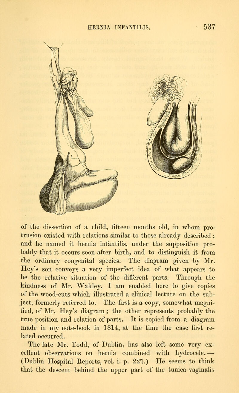 of the dissection of a child, fifteen months old, in whom pro- trusion existed with relations similar to those already described ; and he named it hernia infantilis, under the supposition pro- bably that it occurs soon after birth, and to distinguish it from the ordinary congenital species. The diagram given by Mr. Hey's son conveys a very imperfect idea of what appears to be the relative situation of the different parts. Through the kindness of Mr. Wakley, I am enabled here to give copies of the wood-cuts which illustrated a clinical lecture on the sub- ject, formerly referred to. The first is a copy, somewhat magni- fied, of Mr. Hey's diagram; the other represents probably the true position and relation of parts. It is copied from a diagram made in my note-book in 1814, at the time the case first re- lated occurred. The late Mr. Todd, of Dublin, has also left some very ex- cellent observations on hernia combined with hydrocele.— (Dublin Hospital Eeports, vol. i. p. 227.) He seems to think that the descent behind the upper part of the tunica vaginalis