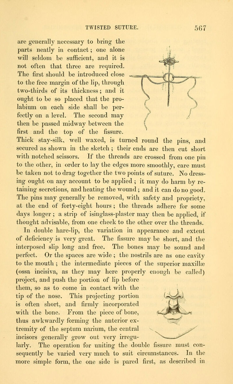 are generally necessary to bring the parts neatly in contact; one alone will seldom be sufficient, and it is not often that three are required. The first should be introduced close to the free margin of the lip, through two-thirds of its thickness; and it ought to be so placed that the pro- labium on each side shall be per- fectly on a level. The second may then be passed midway between the first and the top of the fissure. Thick stay-silk, well waxed, is turned round the pins, and secured as shown in the sketch ; their ends are then cut short with notched scissors. If the threads are crossed from one pin to the other, in order to lay the edges more smoothly, care must be taken not to drag together the two points of suture. No dress- ing ought on any account to be applied ; it may do harm by re- taining secretions, and heating the wound; and it can do no good. The pins may generally be removed, with safety and propriety, at the end of forty-eight hours ; the threads adhere for some days longer ; a strip of isinglass-plaster may then be applied, if thought advisable, from one cheek to the other over the threads. In double hare-lip, the variation in appearance and extent of deficiency is very great. The fissure may be short, and the interposed slip long and free. The bones may be sound and perfect. Or the spaces are wide ; the nostrils are as one cavity to the mouth ; the intermediate pieces of the superior maxillse (ossa incisiva, as they may here properly enough be called) project, and push the portion of lip before them, so as to come in contact with the tip of the nose. This projecting portion is often short, and firmly incorporated with the bone. From the piece of bone, thus awkwardly forming the anterior ex- tremity of the septum narium, the central incisors generally grow out very irregu- larly. The operation for uniting the double fissure must con- sequently be varied very much to suit circumstances. In the more simple form, the one side is pared first, as described in