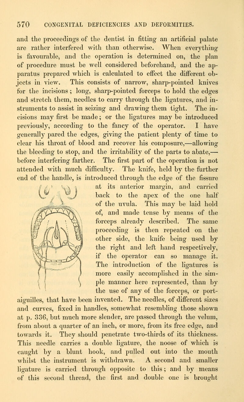 and the proceedings of the dentist in fitting an artificial palate are rather interfered with than otherwise. When everything is favourable, and the operation is determined on, the plan of procedure must be well considered beforehand, and the ap- paratus prepared which is calculated to effect the different ob- jects in view. This consists of narrow, sharp-pointed knives for the incisions ; long, sharp-pointed forceps to hold the edges and stretch them, needles to carry through the ligatures, and in- struments to assist in seizing and drawing them tight. The in- cisions may first be made; or the ligatures may be introduced previously, according to the fancy of the operator. I have generally pared the edges, giving the patient plenty of time to clear his throat of blood and recover his composure,—allowing the bleeding to stop, and the irritability of the parts to abate,— before interfering farther. The first part of the operation is not attended with much difficulty. The knife, held by the further end of the handle, is introduced through the edge of the fissure / |/!) \h \ a^ ^s am^eri°r margin, and carried vT j % lL/ back to the apex of the one half ^JgJ?^ of the uvula. This may be laid hold /2f^^^sfV\ °fi and made tense by means of the lteT i k ' Xm\ forceps already described. The same Iff iOl\' V§d proceeding is then repeated on the 1 M\\ 1/sL il other side, the knife being used by ^w&^M^^-^^gf the right and left hand respectively, vvhl rtff\ if the operator can so manage it. %J ■;,»';^ ~y The introduction of the ligatures is { ! J more easily accomplished in the sim- \ pie manner here represented, than by 1 the use of any of the forceps, or port- aiguilles, that have been invented. The needles, of different sizes and curves, fixed in handles, somewhat resembling those shown at p. 336, but much more slender, are passed through the velum, from about a quarter of an inch, or more, from its free edge, and towards it. They should j^enetrate two-thirds of its thickness. This needle carries a double ligature, the noose of which is caught by a blunt hook, and pulled out into the mouth whilst the instrument is withdrawn. A second and smaller ligature is carried through opposite to this; and by means of this second thread, the first and double one is brought