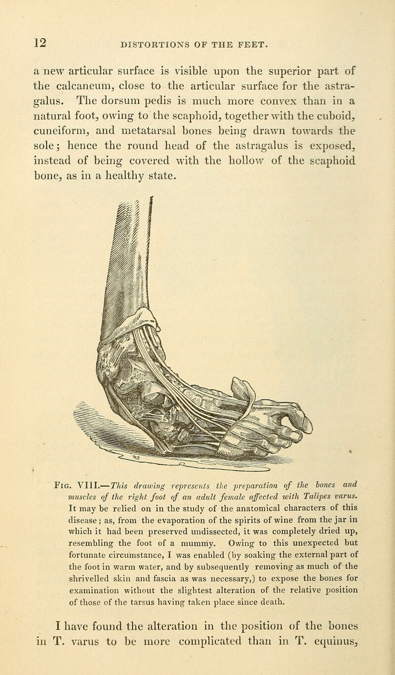 a new articular surface is visible upon the superior part of the calcaneum, close to the articular surface for the astra- galus. The dorsum pedis is much more convex than in a natural foot, owing to the scaphoid, together with the cuboid, cuneiform, and metatarsal bones being drawn towards the sole; hence the round head of the astragalus is exposed, instead of being covered with the hollow of the scaphoid bone, as in a healthy state. Fig. VIII.—This drawing represents the preparation of the bones and muscles of the right foot of an adult female affected with Talipes varus. It may be relied on in the study of the anatomical characters of this disease ; as, from the evaporation of the spirits of wine from the jar in which it had been preserved undissected, it was completely dried up, resembling the foot of a mummy. Owing to this unexpected but fortunate circumstance, I was enabled (by soaking the external part of the foot in warm water, and by subsequently removing as much of the shrivelled skin and fascia as was necessary,) to expose the bones for examination without the slightest alteration of the relative position of those of the tarsus having taken place since death. I have found the alteration in the position of the bones in T. varus to be more complicated than in T. equiims,