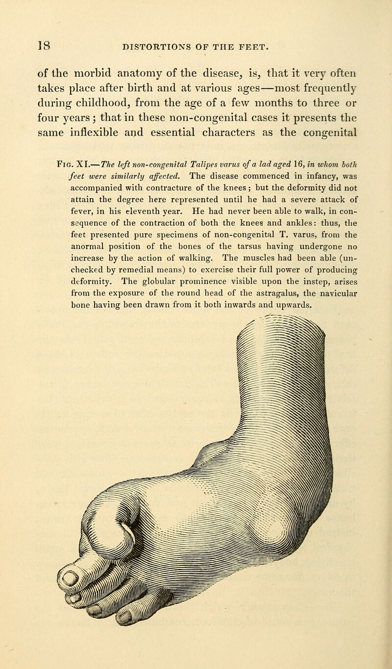 of the morbid anatomy of the disease, is, that it very often takes place after birth and at various ages—most frequently during childhood, from the age of a few months to three or four years; that in these non-congenital cases it presents the same inflexible and essential characters as the congenital Fig. XI.—The left non-congenital Talipes varus of a lad aged 16, in whom both feet were similarly affected. The disease commenced in infancy, was accompanied with contracture of the knees ; but the deformity did not attain the degree here represented until he had a severe attack of fever, in his eleventh year. He had never been able to walk, in con- sequence of the contraction of both the knees and ankles: thus, the feet presented pure specimens of non-congenital T. varus, from the anormal position of the bones of the tarsus having undergone no increase by the action of walking. The muscles had been able (un- checked by remedial means) to exercise their full power of producing deformity. The globular prominence visible upon tbe instep, arises from the exposure of the round bead of the astragalus, the navicular bone having been drawn from it both inwards and upwards.