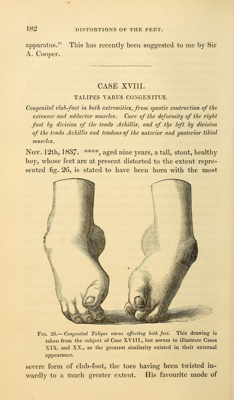 apparatus. This has recently been suggested to me by Sir A. Cooper. CASE XVIII. TALIPES VARUS CONGENITUS. Congenital club-foot in both extremities, from spastic contraction of the extensor and adductor muscles. Cure of the deformity of the right foot by division of the tendo Achillis, and of the left by division of the tendo Achillis and tendons of the anterior and posterior tibial muscles. Nov. 12th, 1837. ****, aged nine years, a tall, stout, healthy boy, whose feet are at present distorted to the extent repre- sented fig. 26, is stated to have been born with the most Fig. 26.— Congenital Talipes varus affecting loth feet. This drawing is taken from the subject of Case XVIII., but serves to illustrate Cases XIX. and XX., as the greatest similarity existed in their external appearance. severe form of club-foot, the toes having been twisted in- wardly to a much greater extent. His favourite mode of