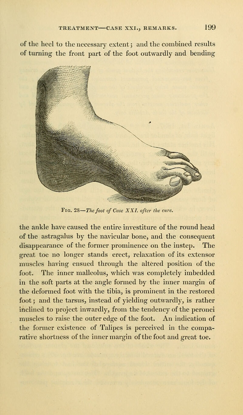 of the heel to the necessary extent; and the combined results of turning the front part of the foot outwardly and bending Fig. 28—The foot of Case XXI. after the cure. the ankle have caused the entire investiture of the round head of the astragalus by the navicular bone, and the consequent disappearance of the former prominence on the instep. The great toe no longer stands erect, relaxation of its extensor muscles having ensued through the altered position of the foot. The inner malleolus, which was completely imbedded in the soft parts at the angle formed by the inner margin of the deformed foot with the tibia, is prominent in the restored foot; and the tarsus, instead of yielding outwardly, is rather inclined to project inwardly, from the tendency of the peronei muscles to raise the outer edge of the foot. An indication of the former existence of Talipes is perceived in the compa- rative shortness of the inner margin of the foot and great toe.