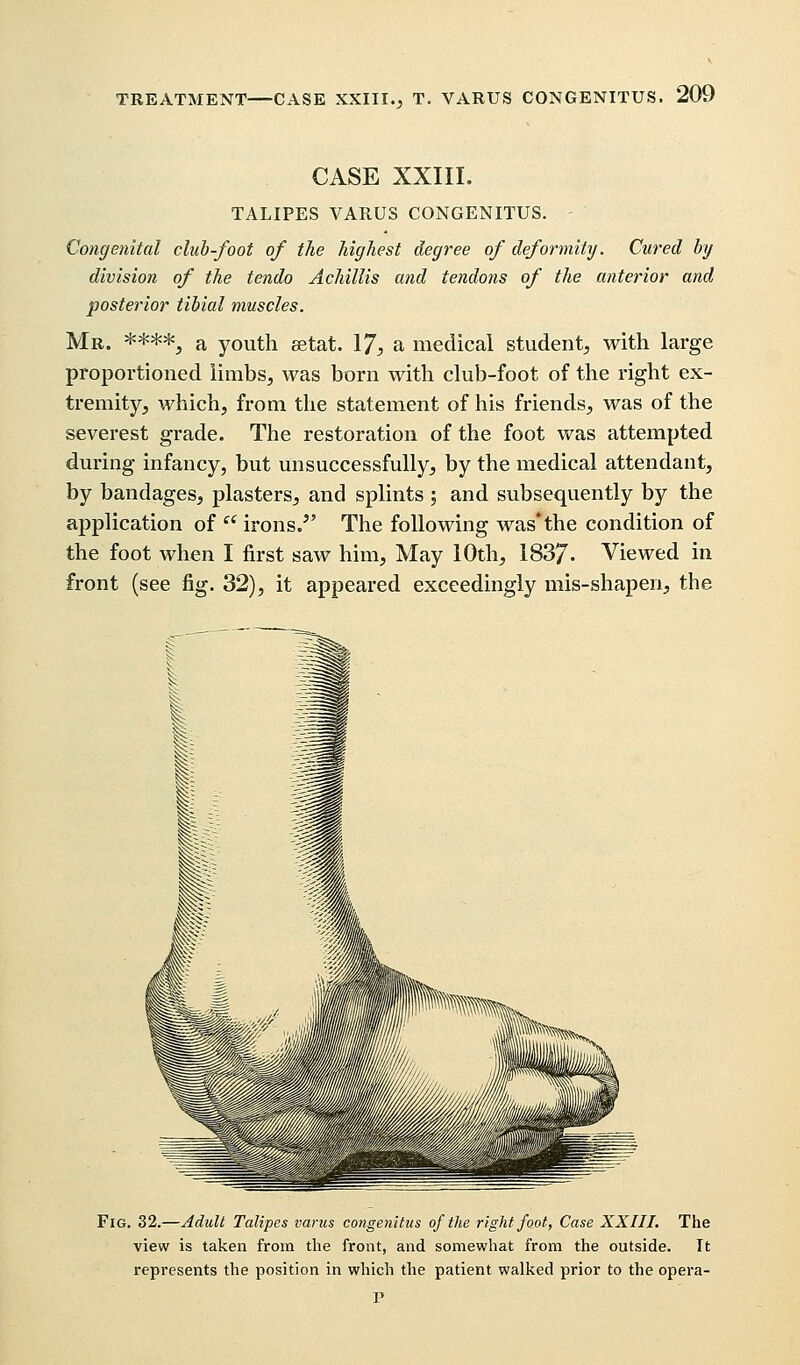 CASE XXIII. TALIPES VARUS CONGENITUS. Congenital club-foot of the highest degree of deformity. Cured by division of the tendo Achillis and tendons of the anterior and posterior tibial muscles. Mr. **##5 a youth setat. 17, a medical student, with large proportioned limbs, was born with club-foot of the right ex- tremity, which, from the statement of his friends, was of the severest grade. The restoration of the foot was attempted during infancy, but unsuccessfully, by the medical attendant, by bandages, plasters, and splints ; and subsequently by the application of  irons/' The following was*the condition of the foot when I first saw him, May 10th, 1837- Viewed in front (see fig. 32), it appeared exceedingly mis-shapen, the Fig. 32.—Adult Talipes varus congenitus of the right foot, Case XXIII. The view is taken from the front, and somewhat from the outside. It represents the position in which the patient walked prior to the opera- P