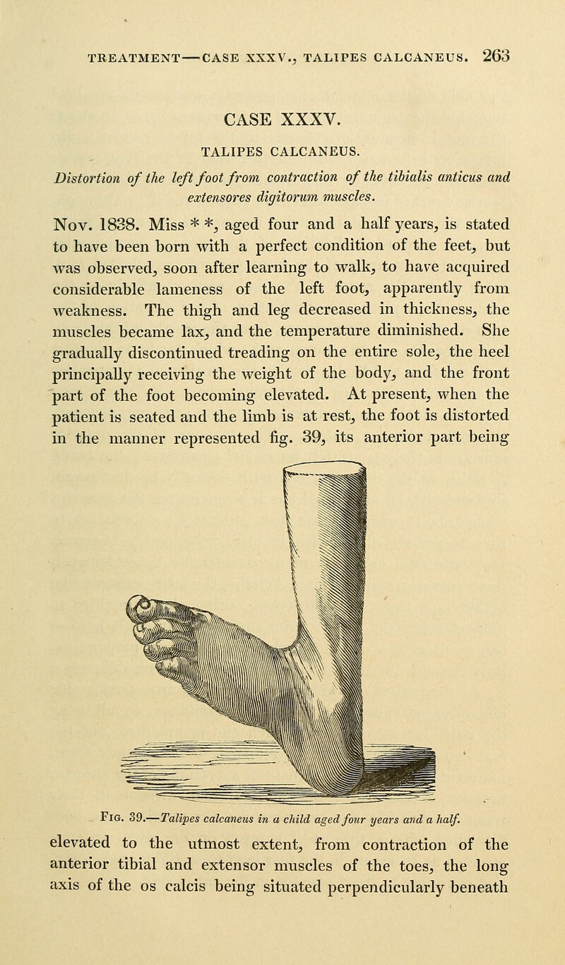 CASE XXXV. TALIPES CALCANEUS. Distortion of the left foot from contraction of the tibialis anticus and extensores digitorum muscles. Nov. 1838. Miss * *, aged four and a half years, is stated to have been born with a perfect condition of the feet, but was observed, soon after learning to walk, to have acquired considerable lameness of the left foot, apparently from weakness. The thigh and leg decreased in thickness, the muscles became lax, and the temperature diminished. She gradually discontinued treading on the entire sole, the heel principally receiving the weight of the body, and the front part of the foot becoming elevated. At present, when the patient is seated and the limb is at rest, the foot is distorted in the manner represented fig. 39, its anterior part being - Fig. 39.—Talipes calcaneus in a child aged four years and a half. elevated to the utmost extent, from contraction of the anterior tibial and extensor muscles of the toes, the long axis of the os calcis being situated perpendicularly beneath