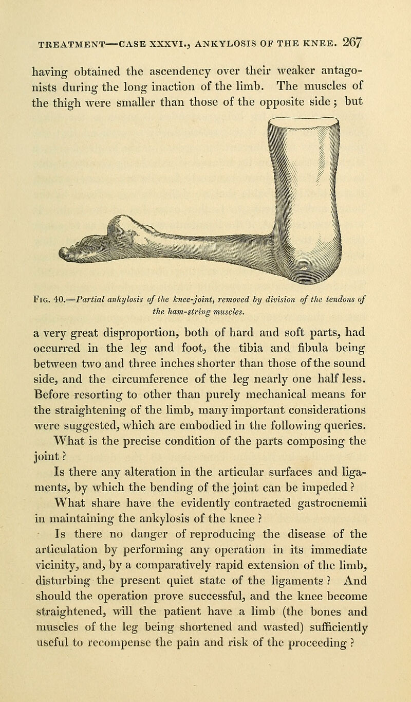 having obtained the ascendency over their weaker antago- nists during the long inaction of the limb. The muscles of the thigh were smaller than those of the opposite side; but Fig. 40.—Partial ankylosis of the knee-joint, removed by division of the tendons of the ham-string muscles. a very great disproportion, both of hard and soft parts, had occurred in the leg and foot, the tibia and fibula being between two and three inches shorter than those of the sound side, and the circumference of the leg nearly one half less. Before resorting to other than purely mechanical means for the straightening of the limb, many important considerations were suggested, which are embodied in the following queries. What is the precise condition of the parts composing the joint ? Is there any alteration in the articular surfaces and liga- ments, by which the bending of the joint can be impeded ? What share have the evidently contracted gastrocnemii in maintaining the ankylosis of the knee ? Is there no danger of reproducing the disease of the articulation by performing any operation in its immediate vicinity, and, by a comparatively rapid extension of the limb, disturbing the present quiet state of the ligaments ? And should the operation prove successful, and the knee become straightened, will the patient have a limb (the bones and muscles of the leg being shortened and wasted) sufficiently useful to recompense the pain and risk of the proceeding ?