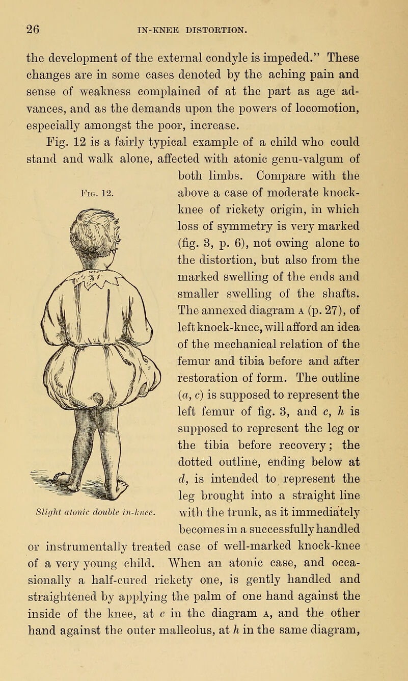 Fig. 12. the development of the external condyle is impeded. These changes are in some cases denoted by the aching pain and sense of weakness complained of at the part as age ad- vances, and as the demands upon the powers of locomotion, especially amongst the poor, increase. Fig. 12 is a fairly typical example of a child who could stand and walk alone, affected with atonic genu-valgum of both limbs. Compare with the above a case of moderate knock- knee of rickety origin, in which loss of symmetry is very marked (fig. 3, p. 6), not owing alone to the distortion, but also from the marked swelling of the ends and smaller swelling of the shafts. The annexed diagram a (p. 27), of left knock-knee, will afford an idea of the mechanical relation of the femur and tibia before and after restoration of form. The outline (a, c) is supposed to represent the left femur of fig. 3, and c, h is supposed to represent the leg or the tibia before recovery; the dotted outline, ending below at d, is intended to represent the leg brought into a straight line with the trunk, as it immediately becomes in a successfully handled or instrumentally treated case of well-marked knock-knee of a very young child. When an atonic case, and occa- sionally a half-cured rickety one, is gently handled and straightened by applying the palm of one hand against the inside of the knee, at c in the diagram a, and the other hand against the outer malleolus, at h in the same diagram, Slight atonic double in-hnee.