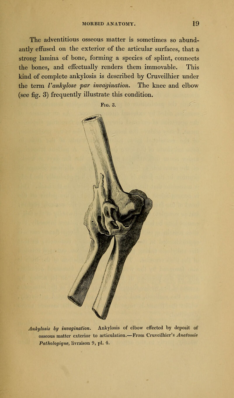 The adventitious osseous matter is sometimes so abund- antly effused on the exterior of the articular surfaces, that a strong lamina of bone, forming a species of splint, connects the bones, and effectually renders them immovable. This kind of complete ankylosis is described by Cruveilhier under the term Vankylose par invagination. The knee and elbow (see fig. 3) frequently illustrate this condition. Fig. 3. Ankylosis by invagination. Ankylosis of elbow effected by deposit of osseous matter exterior to articulation.—From Cruveilhier's Anatomie Pathologique, livraison 9, pi. 4.