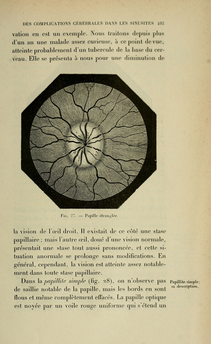 vation en est un exemple. Nous Iraitons depuis plus d'un an une malade assez curieuse, à ce point de vue, atteinte probablement d'un tubercule de la base du cer- veau. Elle se présenta à nous pour une diminution de FiG. ■:!. Papille étranglée. la vision de l'œil droit. Il existait de ce côte une stase papillaire ; mais l'autre œil, doué d'une vision normale, présentait une stase tout aussi prononcée, et cette si- tuation anormale se prolonge sans modifications. En général, cependant, la vision est atteinte assez notable- ment dans toute stase papillaire. Dans \aipapillite simple (fig. .'38), on n'observe pas PapiiiUesimple: de saillie notable de la papille, mais les bords en sont * ebLnpion. flous et même complètement effacés. La papille optique est noyée par un voile rouge uniforme qui s'étend un