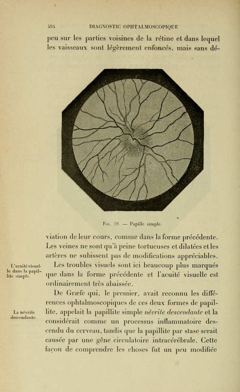 peu sur les parties voisines de la rétine et dans lequel les vaisseaux sont légèrement enfoncés, mais sans dé- L'acuité visuel- le dans la papil- iple. lile La nc^Tile descendante. FiG. 28. — Papille simple. Aviation de leur cours, comme dans la forme précédente. Les veines ne sont qu'à peine tortueuses et dilatées et les artères ne subissent pas de modifications appréciables. Les troubles visuels sont ici beaucoup plus marqués que dans la forme précédente et l'acuité visuelle est ordinairement très abaissée. De Gr£pfe qui, le premier, avait reconnu les diffé- rences ophtalmoscopiques de ces deux formes de jDapil- lite, appelait la papillite simple névrite descendante et la considérait comme un processus inflammatoire des- cendu du cerveau, tandis que la papillite par stase serait causée par une gêne circulatoire intracérébrale. Cette façon de comprendre les choses fut un peu modifiée