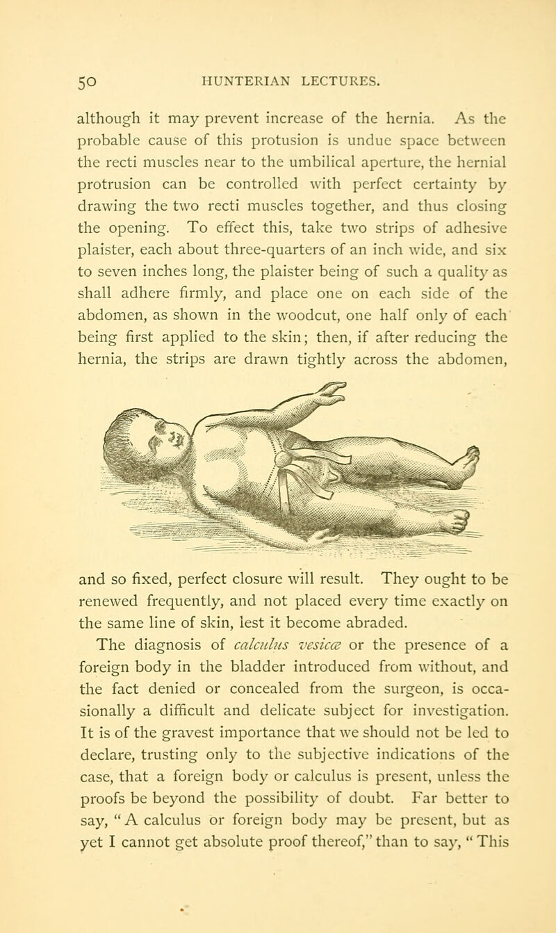although it may prevent increase of the hernia. As the probable cause of this protusion is undue space between the recti muscles near to the umbilical aperture, the hernial protrusion can be controlled with perfect certainty by drawing the two recti muscles together, and thus closing the opening. To effect this, take two strips of adhesive plaister, each about three-quarters of an inch wide, and six to seven inches long, the plaister being of such a quality as shall adhere firmly, and place one on each side of the abdomen, as shown in the woodcut, one half only of each' being first applied to the skin; then, if after reducing the hernia, the strips are drawn tightly across the abdomen. and so fixed, perfect closure will result. They ought to be renewed frequently, and not placed every time exactly on the same line of skin, lest it become abraded. The diagnosis of calculus vcsiccu or the presence of a foreign body in the bladder introduced from without, and the fact denied or concealed from the surgeon, is occa- sionally a difficult and delicate subject for investigation. It is of the gravest importance that we should not be led to declare, trusting only to the subjective indications of the case, that a foreign body or calculus is present, unless the proofs be beyond the possibility of doubt. Far better to say,  A calculus or foreign body may be present, but as yet I cannot get absolute proof thereof, than to say,  This