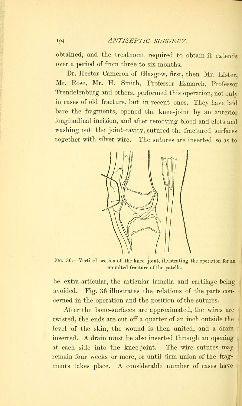 obtained, and the treatment required to obtain it extends over a period of from three to six months. Dr. Hector Cameron of Grlasgow, first, then Mr. Lister, Mr. Eose, Mr. H. Smith, Professor Esmarch, Professor Trendelenburg and others, performed this operation, not only in cases of old fracture, but in recent ones. They have laid bare the fragments, opened the knee-joint by an anterior longitudinal incision, and after removing blood and clots and washing out the joint-cavity, sutured the fractured surfaces together with silver wire. The sutures are inserted so as to ii{j. 36.—Vertical section of the knee joint, illustrating the operation for an ununited fracture of the patella. be extra-articular, the articular lamella and cartilage being avoided. Fig. 36 illustrates the relations of the parts con- cerned in the operation and the position of the sutures. After the bone-surfaces are approximated, the wires are twisted, the ends are cut off a quarter of an inch outside the level of the skin, the wound is then united, and a drain inserted. A drain must be also inserted through an opening at each side into the knee-joint. The wire sutures may remain four weeks or more, or until firm union of the frag- ments takes place. A considerable number of cases have