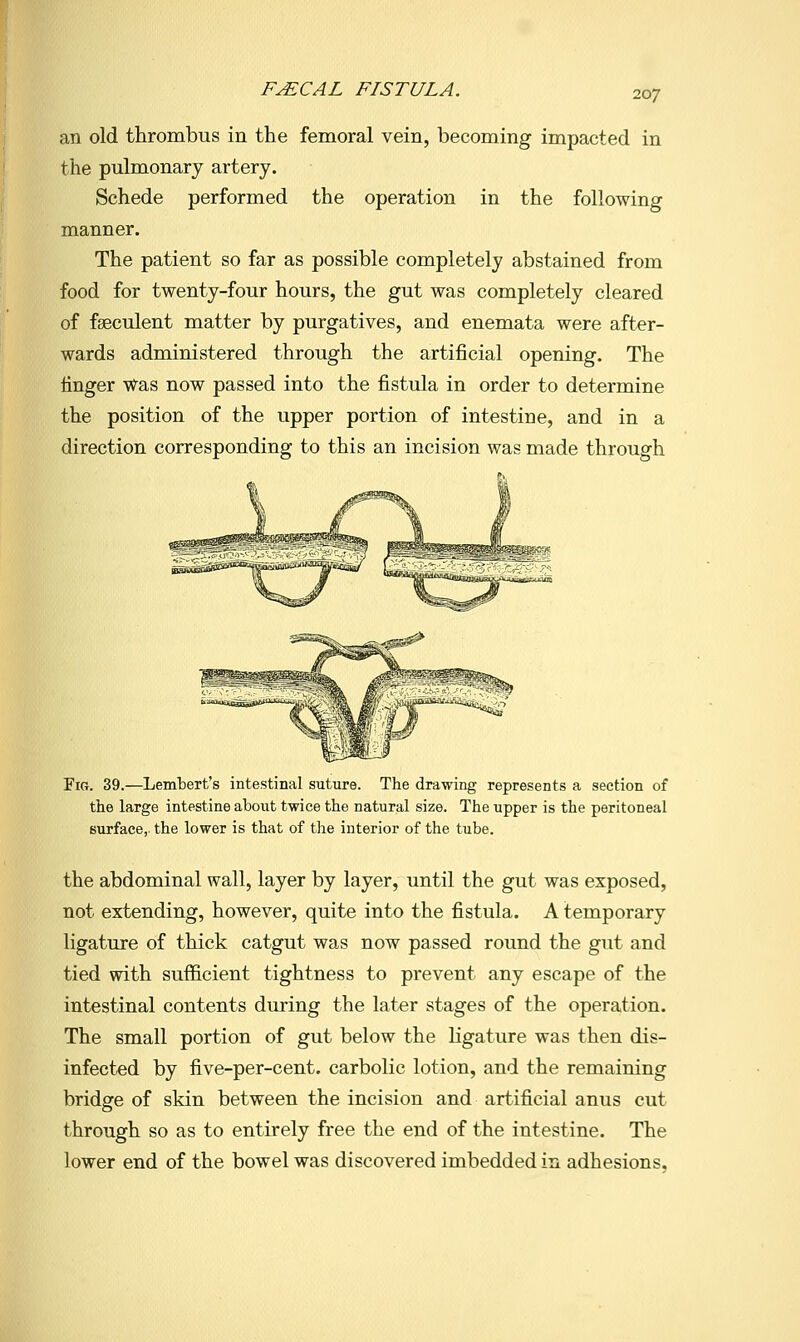 an old thrombus in the femoral vein, becoming impacted in the pulmonary artery. Schede performed the operation in the following manner. The patient so far as possible completely abstained from food for twenty-four hours, the gut was completely cleared of fgeculent matter by purgatives, and enemata were after- wards administered through the artificial opening. The linger Was now passed into the fistula in order to determine the position of the upper portion of intestine, and in a direction corresponding to this an incision was made through Fig. 39.—Lembert's intestinal suture. The drawing represents a section of the large intestine about twice the natural size. The upper is the peritoneal surface,, the lower is that of the interior of the tube. the abdominal wall, layer by layer, until the gut was exposed, not extending, however, quite into the fistula. A temporary ligature of thick catgut was now passed round the gut and tied with sufficient tightness to prevent any escape of the intestinal contents during the later stages of the operation. The small portion of gut below the ligature was then dis- infected by five-per-cent. carbolic lotion, and the remaining bridge of skin between the incision and artificial anus cut through so as to entirely free the end of the intestine. The lower end of the bowel was discovered imbedded in adhesions.