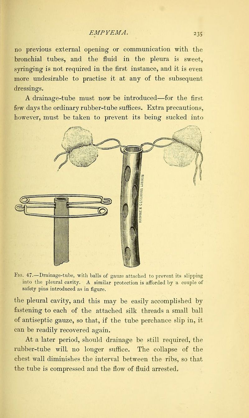 EMPYEMA. no previous external opening or communication with the bronchial tubes, and the fluid in the pleura is sweet, syringing is not required in the first instance, and it is even more undesirable to practise it at any of the subsequent dressings. A drainage-tube must now be introduced—for the first few days the ordinary rubber-tube suffices. Extra precautions, however, must be taken to prevent its being sucked into Fig. 47.—Drainage-Uibe, with balls of gauze attached to prevent its slipping into the pleural cavity. A similar protection is afforded by a couple of safety pins introduced as in figure. the pleural cavity, and this may be easily accomplished by fastening to each of the attached silk threads a small ball of antiseptic gauze, so that, if the tube perchance slip in, it can be readily recovered again. At a later period, should drainage be still reqmred, the rubber-tube will, no longer suffice. The collapse of the chest wall diminishes the interval between the ribs, so that the tube is compressed and the flow of fluid arrested.
