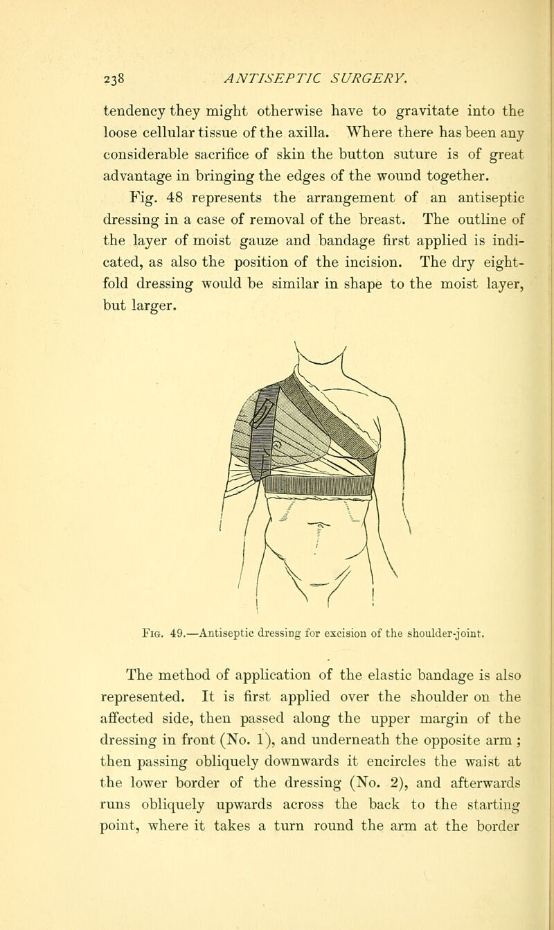 tendency they might otherwise have to gravitate into the loose cellular tissue of the axilla. Where there has been any considerable sacrifice of skin the button suture is of great advantage in bringing the edges of the wound together. Fig. 48 represents the arrangement of an antiseptic dressing in a case of removal of the breast. The outline of the layer of moist gauze and bandage first applied is indi- cated, as also the position of the incision. The dry eight- fold dressing would be similar in shape to the moist layer, but larger. Fig. 49.—Antiseptic dressing for excision of the shoulder-joint. The method of application of the elastic bandage is also represented. It is first applied over the shoulder on the afifected side, then passed along the upper margin of the dressing in front (No. 1), and underneath the opposite arm ; then passing obliquely downwards it encircles the waist at the lower border of the dressing (No. 2), and afterwards runs obliquely upwards across the back to the starting point, where it takes a turn round the arm at the border