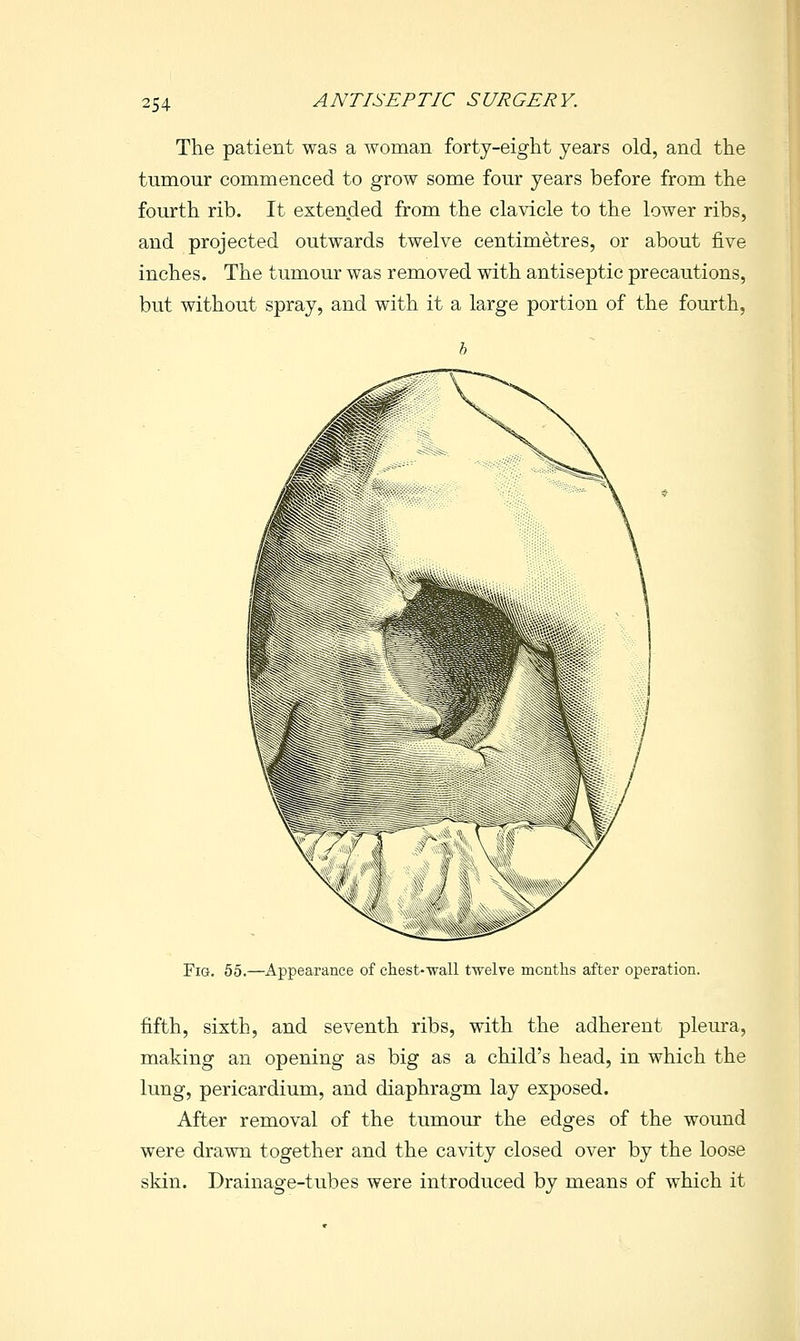 The patient was a woman forty-eight years old, and the tumour commenced to grow some four years before from the fourth rib. It extended from the clavicle to the lower ribs, and projected outwards twelve centimetres, or about five inches. The tumour was removed with antiseptic precautions, but without spray, and with it a large portion of the fourth, Fig. 55.—Appearance of chest-wall twelve months after operation. fifth, sixth, and seventh ribs, with the adherent pleura, making an opening as big as a child's head, in which the lung, pericardium, and diaphragm lay exposed. After removal of the tumour the edges of the wound were drawn together and the cavity closed over by the loose skin. Drainage-tubes were introduced by means of which it