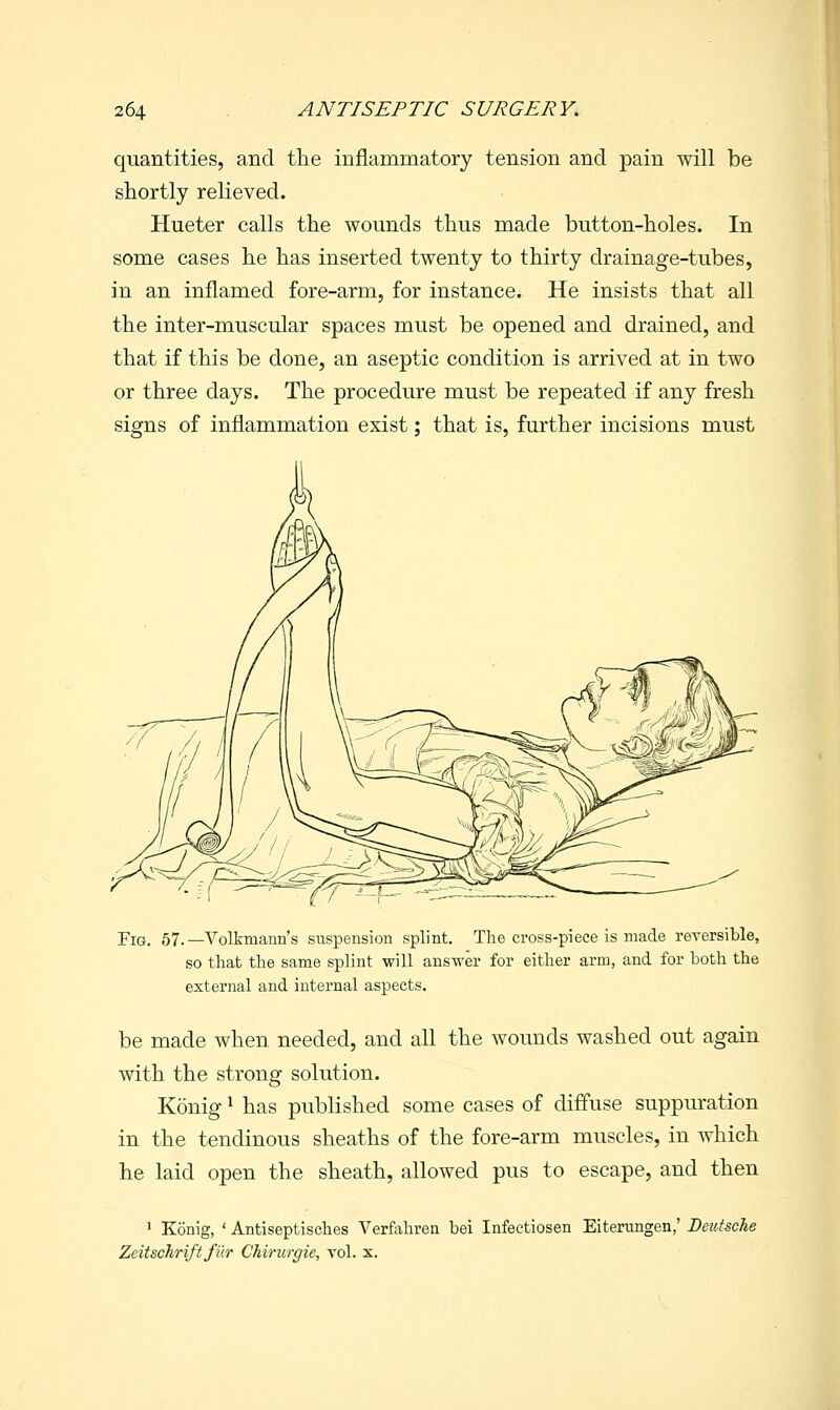 quantities, and the inflammatory tension and pain will be shortly relieved. Hueter calls the wounds thus made button-holes. In some cases he has inserted twenty to thirty drainage-tubes, in an inflamed fore-arm, for instance. He insists that all the inter-muscular spaces must be opened and drained, and that if this be done, an aseptic condition is arrived at in two or three days. The procedure must be repeated if any fresh signs of inflammation exist; that is, further incisions must Fig. 57.—Volkmann's suspension splint. The cross-piece is made reversible, so that the same splint will answer for either arm, and for both the external and internal aspects. be made when needed, and all the wounds washed out again with the strong solution. Konig ^ has published some cases of diffuse suppuration in the tendinous sheaths of the fore-arm muscles, in which he laid open the sheath, allowed pus to escape, and then ' Konig, ' Antiseptisches Verfahren bei Infeetiosen Eiteningen,' Deutsche Zeitschrift fiir Chirurgie, vol. x.