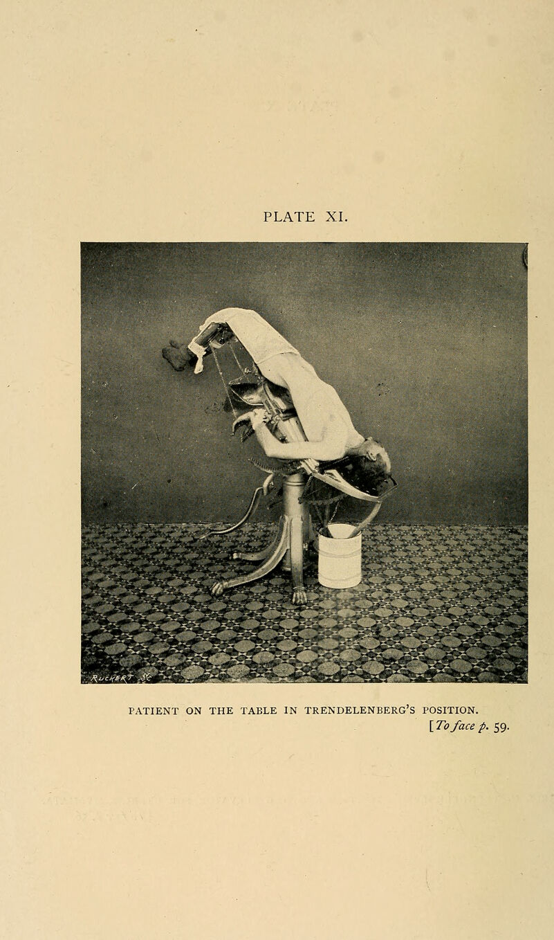 PLATE XI. PATIENT ON THE TABLE IN TRENDELENBERG'S POSITION.