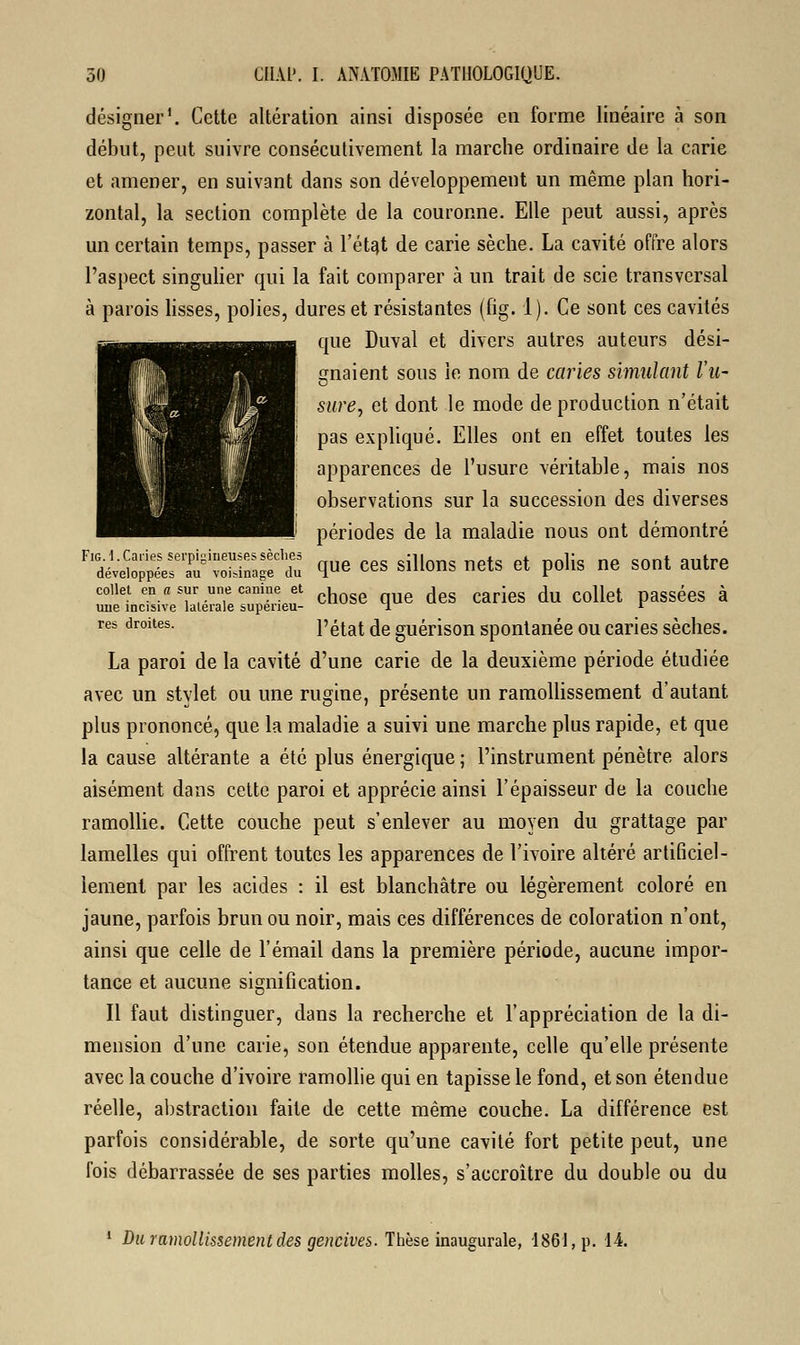 désigner1. Cette altération ainsi disposée en forme linéaire à son début, peut suivre consécutivement la marche ordinaire de la carie et amener, en suivant dans son développement un même plan hori- zontal, la section complète de la couronne. Elle peut aussi, après un certain temps, passer à l'état de carie sèche. La cavité offre alors l'aspect singulier qui la fait comparer à un trait de scie transversal à parois lisses, polies, dures et résistantes (fig. 1). Ce sont ces cavités que Duval et divers autres auteurs dési- gnaient sous le nom de caries simulant Vu- sure, et dont le mode de production n'était pas expliqué. Elles ont en effet toutes les apparences de l'usure véritable, mais nos observations sur la succession des diverses périodes de la maladie nous ont démontré ^iSSS^'SSS^ que ces sillons nets et polis ne sont autre collet en « sur une canine et fa d ieg du jj t passées à une incisive latérale supeneu- 1 * res droites. l'état de guérison spontanée ou caries sèches. La paroi de la cavité d'une carie de la deuxième période étudiée avec un stylet ou une rugine, présente un ramollissement d'autant plus prononcé, que la maladie a suivi une marche plus rapide, et que la cause altérante a été plus énergique ; l'instrument pénètre alors aisément dans cette paroi et apprécie ainsi l'épaisseur de la couche ramollie. Cette couche peut s'enlever au moyen du grattage par lamelles qui offrent toutes les apparences de l'ivoire altéré artificiel- lement par les acides : il est blanchâtre ou légèrement coloré en jaune, parfois brun ou noir, mais ces différences de coloration n'ont, ainsi que celle de l'émail dans la première période, aucune impor- tance et aucune signification. Il faut distinguer, dans la recherche et l'appréciation de la di- mension d'une carie, son étendue apparente, celle qu'elle présente avec la couche d'ivoire ramollie qui en tapisse le fond, et son étendue réelle, abstraction faite de cette même couche. La différence est parfois considérable, de sorte qu'une cavité fort petite peut, une fois débarrassée de ses parties molles, s'accroître du double ou du 1 Du ramollissement des gencives. Thèse inaugurale, 1861, p. 14.