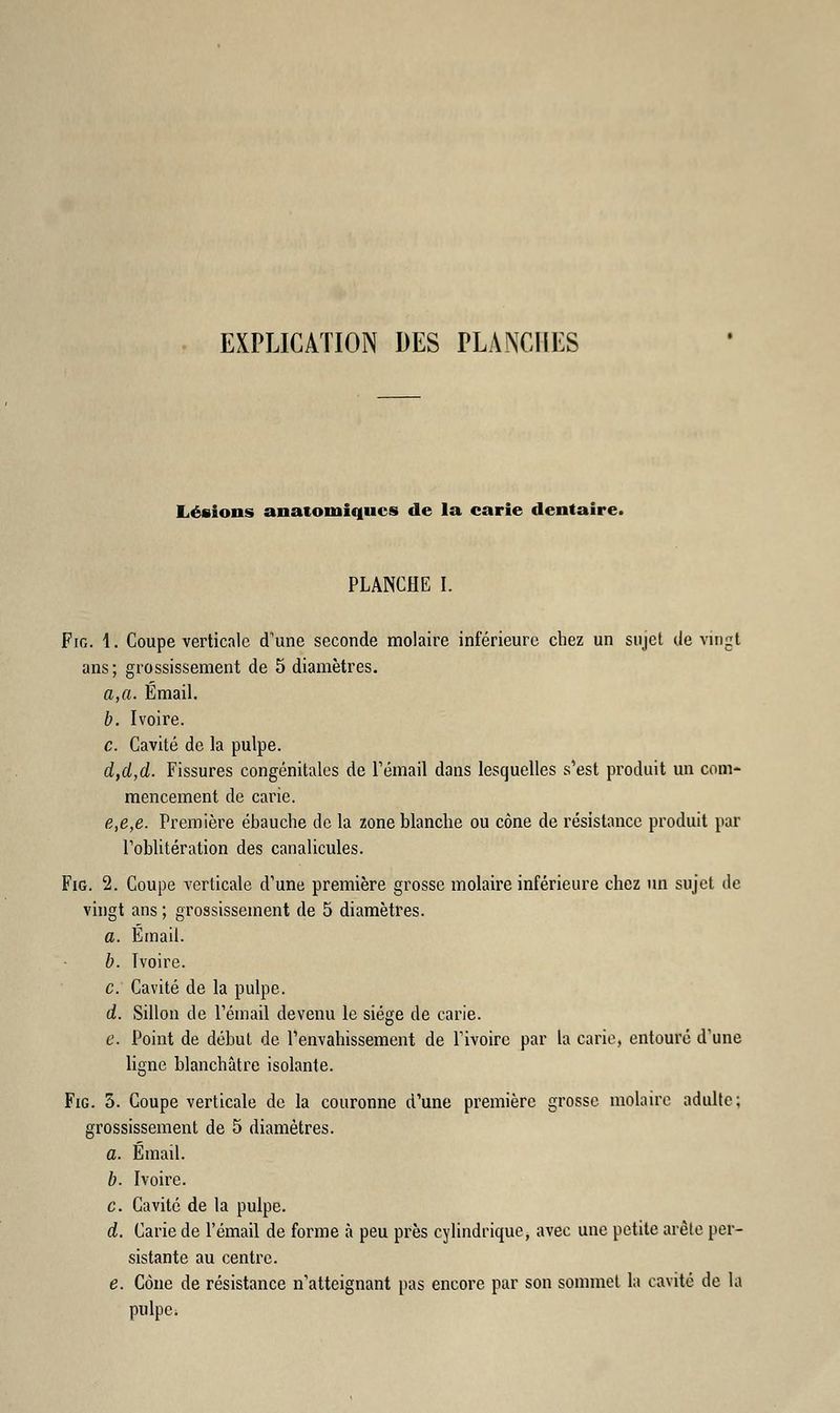 EXPLICATION DES PLANCHES Lésions anatomiques de la carie dentaire. PLANCHE I. Fie. 1. Coupe verticale (Tune seconde molaire inférieure chez un sujet de vingt ans; grossissement de 5 diamètres. a,a. Émail. b. Ivoire. c. Cavité de la pulpe. d,d,d. Fissures congénitales de rémail dans lesquelles s'est produit un com- mencement de carie. e,e,e. Première ébauche de la zone blanche ou cône de résistance produit par l'oblitération des canalicules. Fig. 2. Coupe verticale d'une première grosse molaire inférieure chez un sujet de vingt ans ; grossissement de 5 diamètres. a. Émail. b. Ivoire. c. Cavité de la pulpe. d. Sillon de l'émail devenu le siège de carie. c. Point de début de l'envahissement de l'ivoire par la carie, entouré d'une ligne blanchâtre isolante. Fig. 5. Coupe verticale de la couronne d'une première grosse molaire adulte; grossissement de 5 diamètres. a. Émail. b. Ivoire. c. Cavité de la pulpe. d. Carie de l'émail de forme à peu près cylindrique, avec une petite arête per- sistante au centre. e. Cône de résistance n'atteignant pas encore par son sommet la cavité de la pulpe;