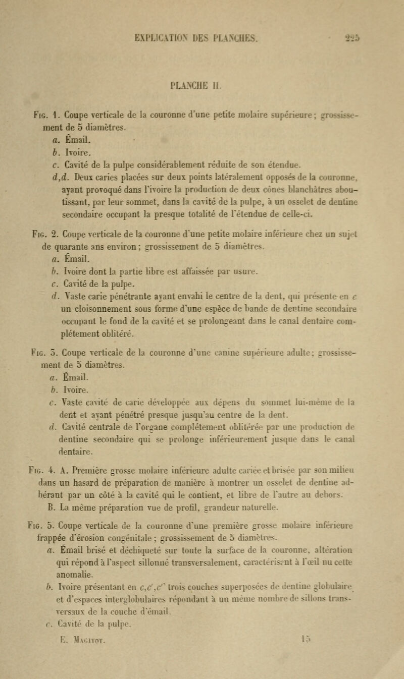 PLANCHE II Fig. 1. Coupe verticale de la couronne d'une petite molaire ment de 5 diamètres. a. Émail. b. Ivoire. c. Cavité de la pulpe considérablement réduite de son étendu»'. d,d. Deux caries placées sur deux points latéralement opposés de la couronne, ayant provoqué dans l'ivoire la production de deux cônes blanchâtres abou- tissant, par leur sommet, dans la cavité de la pulpe, à un osselet de deuline secondaire occupant la presque totalité de l'étendue de celle-ci. Fig. 2. Coupe verticale de la couronne d'une petite molaire inférieure chez un sujet de quarante ans environ: frrossisseinent de 5 diamètre. a. Émail. b. Ivoire dont la partie libre est affaissée par usure. c. Cavité de la pulpe. d. Vaste carie pénétrante ayant envahi le centre de la dent, qui présente en c un cloisonnement sous forme d'une espèce de bande de dentine secondaire occupant le fond de la cavité et se prolongeant dans le canal dentaire com- plètement oblitéré. Fig. 3. Coupe verticale de la couronne d'une canine supérieure adulte ; gros ment de 5 diamètres. a. Émail. b. Ivoire. C. Vaste cavité de cane développée aux dépens du sommet lui-même de la dent et avant pénétré presque jusqu'au centre de la dent. d. Cavité centrale de l'organe complètement oblitérée par une production de dentiue secondaire qui se prolonge inférieurement jusque dans le canal dentaire. Fig. 4. A. lYemière grosse molaire inférieure adulte cariée et brisée par son milieu dans un hasard de préparation de manière à montrer un osselet de dentine hérant par un côté à la cavité qui le contient, et libre de l'autre au deboi - B. La même préparation vue de profil, grandeur naturelle. Fig. 5. Coupe verticale de la couronne d'une première grosse molaire inférieure frappée d'érosion congénitale ; grossissement de 5 diamèù - a. Émail brisé et déchiqueté sur toute la surlace de la couronne, altération qui répond à l'aspect sillonué transversalement, caractérisent à 1 œil nu cette anomalie. />. Ivoire présentant en ce ,c trois couches superposées de dentine globulaire et d'espaces interglobulaires répondant à un même nombre de sillons trans- versaux de la couche d'émail. c. Cavité de la pulpe.