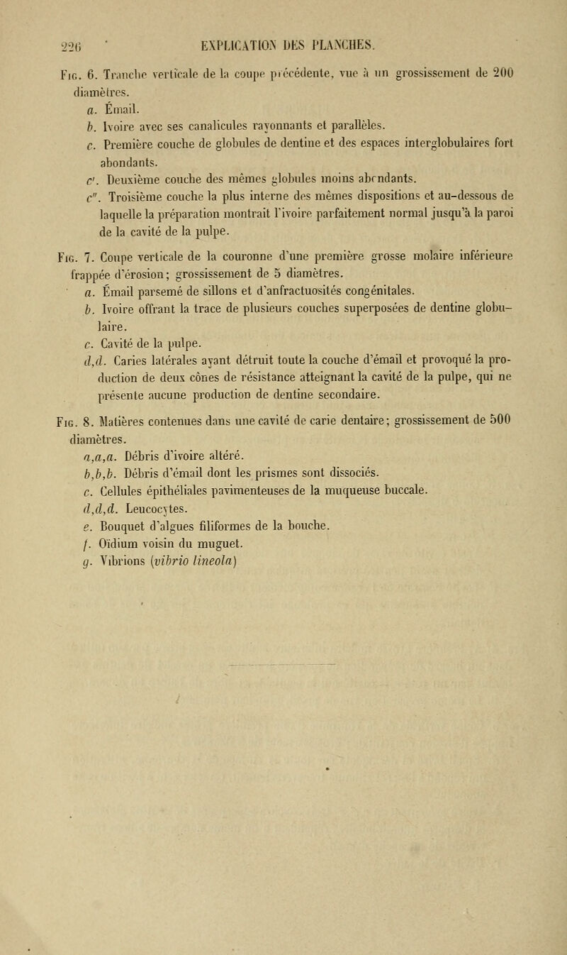 Fin. 6. Tranche verticale de la coupe précédente, vue à un grossissement de 200 diamètres. a. Email. b. Ivoire avec ses canalicules rayonnants et parallèles. c Première couche de globules de dentine et des espaces interglobulaires fort abondants. c'. Deuxième couche des mêmes globules moins abrndants. c. Troisième couche la plus interne des mêmes dispositions et au-dessous de laquelle la préparation montrait l'ivoire parfaitement normal jusqu'à la paroi de la cavité de la pulpe. Fig. 7. Coupe verticale de la couronne d'une première grosse molaire inférieure frappée d'érosion; grossissement de 5 diamètres. a. Émail parsemé de sillons et d'anfractuosités congénitales. b. Ivoire offrant la trace de plusieurs couches superposées de dentine globu- laire. c. Cavité de la pulpe. d,d. Caries latérales ayant détruit toute la couche d'émail et provoqué la pro- duction de deux cônes de résistance atteignant la cavité de la pulpe, qui ne présente aucune production de dentine secondaire. Fig. 8. Matières contenues dans une cavité de carie dentaire; grossissement de 500 diamètres. a,a,a. Débris d'ivoire altéré. b,b,b. Débris d'émail dont les prismes sont dissociés. c. Cellules épithéliales pavimenteuses de la muqueuse buccale. d,d,d. Leucocytes. e. Bouquet d'algues filiformes de la bouche. /. Oïdium voisin du muguet. g. Vibrions [vibrio lineola)