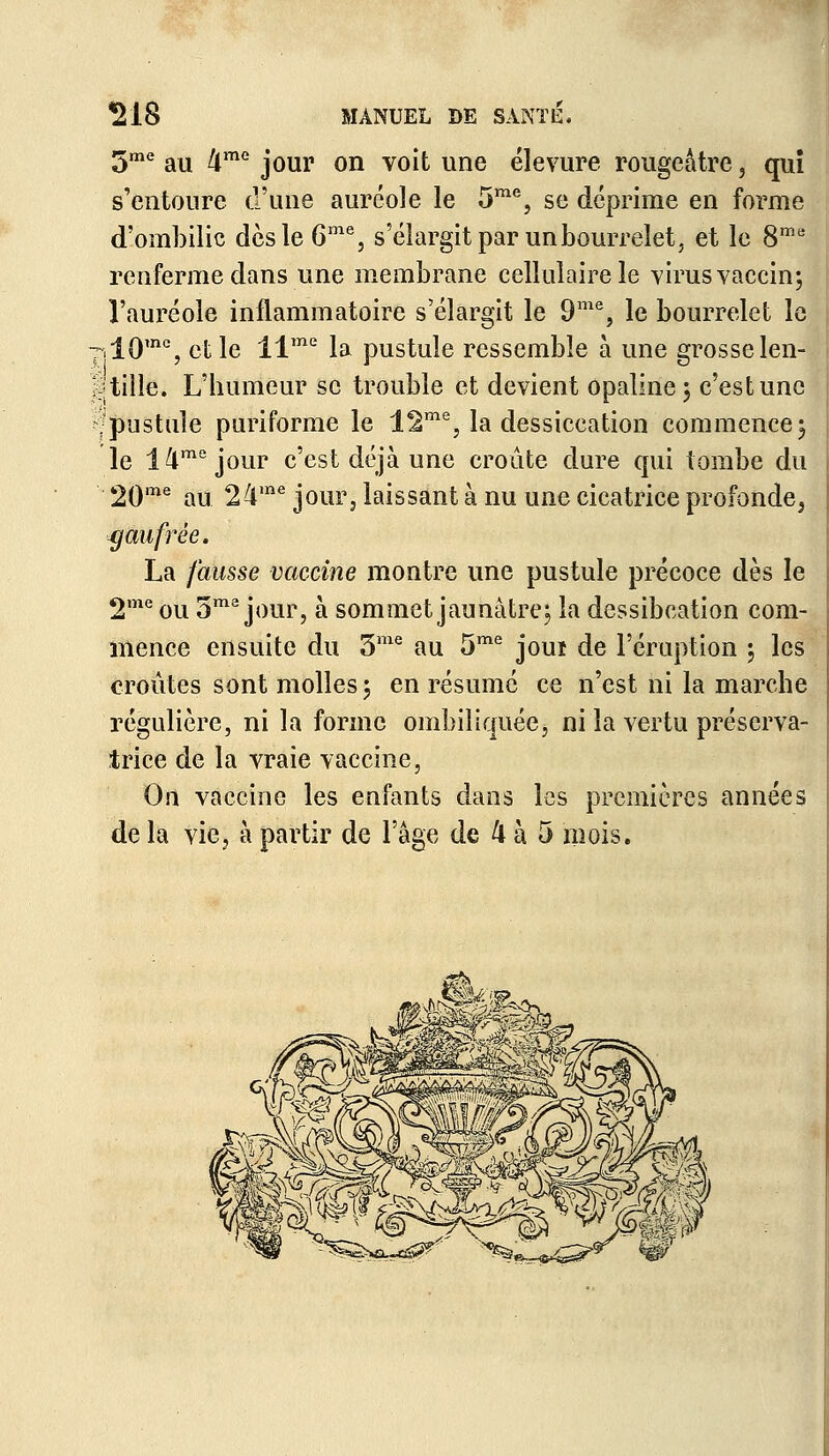 5me au 4me jour on voit une élevure rougeàtre, qui s'entoure d'une auréole le 5me, se déprime en forme d'ombilic des le 6m% s'élargit par un bourrelet, et le 8me renferme dans une membrane cellulaire le virus vaccin; l'auréole inflammatoire s'élargit le 9me, le bourrelet le iOm% et le llme la pustule ressemble à une grosselen- ;tille. L'humeur se trouble et devient opaline ; c'est une •pustule puriforme le 12me, la dessiccation commence3 le 14mejour c'est déjà une croûte dure qui tombe du 20me au 24me jour, laissant à nu une cicatrice profonde, gaufrée. La fausse vaccine montre une pustule précoce dès le 2me ou oma jour, à sommet jaunâtre; la dessibcation com- mence ensuite du 3me au 5me joui de l'éruption ; les croûtes sont molles; en résume ce n'est ni la marche régulière, ni la forme ombiliquéej ni la vertu préserva- trice de la vraie vaccine, On vaccine les enfants dans les premières années