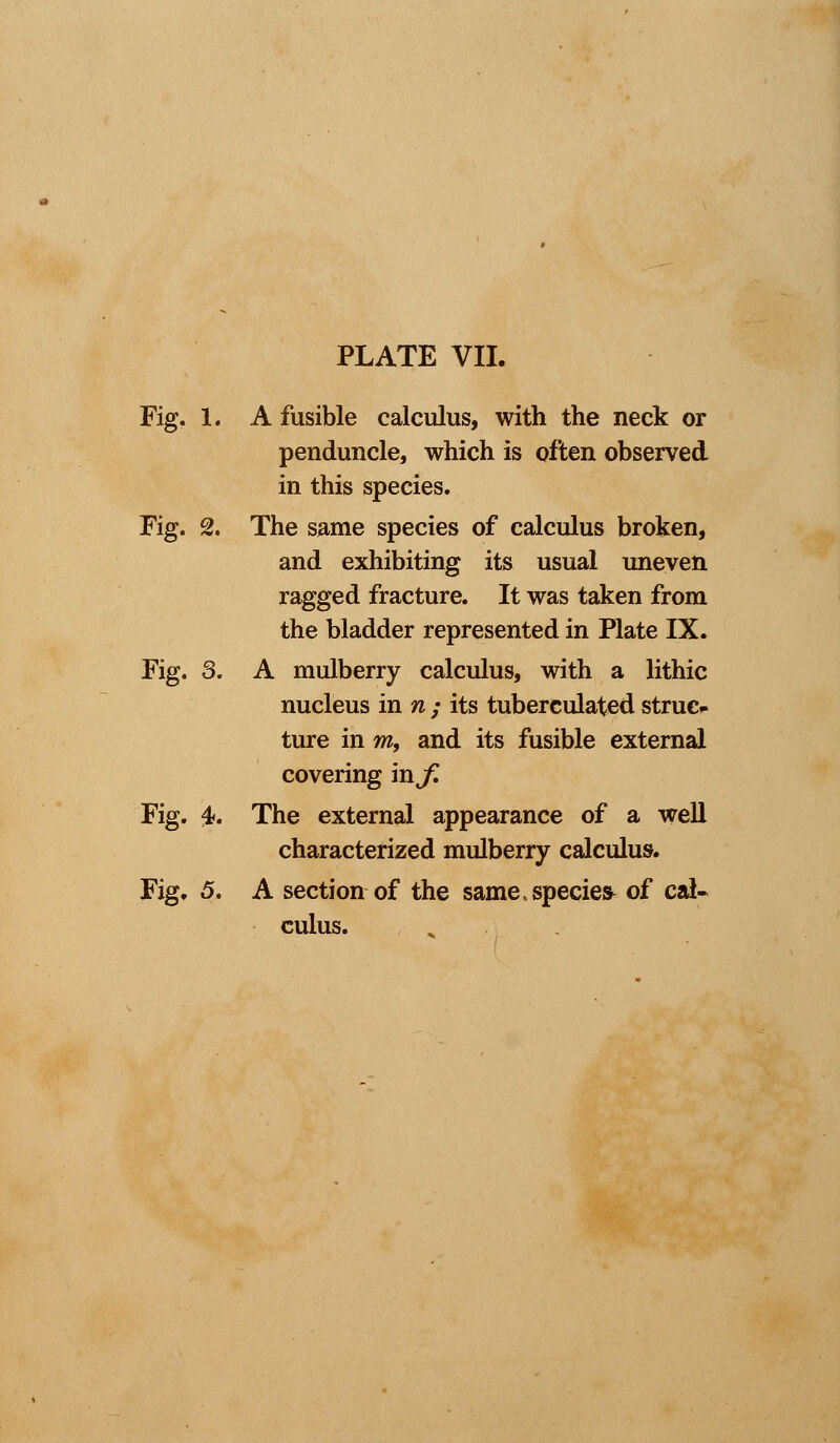 Fig. 1. A fusible calculus, with the neck or penduncle, which is often observed in this species. Fig. % The same species of calculus broken, and exhibiting its usual uneven ragged fracture. It was taken from the bladder represented in Plate IX. Fig. 3. A mulberry calculus, with a lithic nucleus in n ; its tuberculated struc- ture in mf and its fusible external covering in^ Fig. 4. The external appearance of a well characterized mulberry calculus. Fig. 5. A section of the same species of cal- culus.
